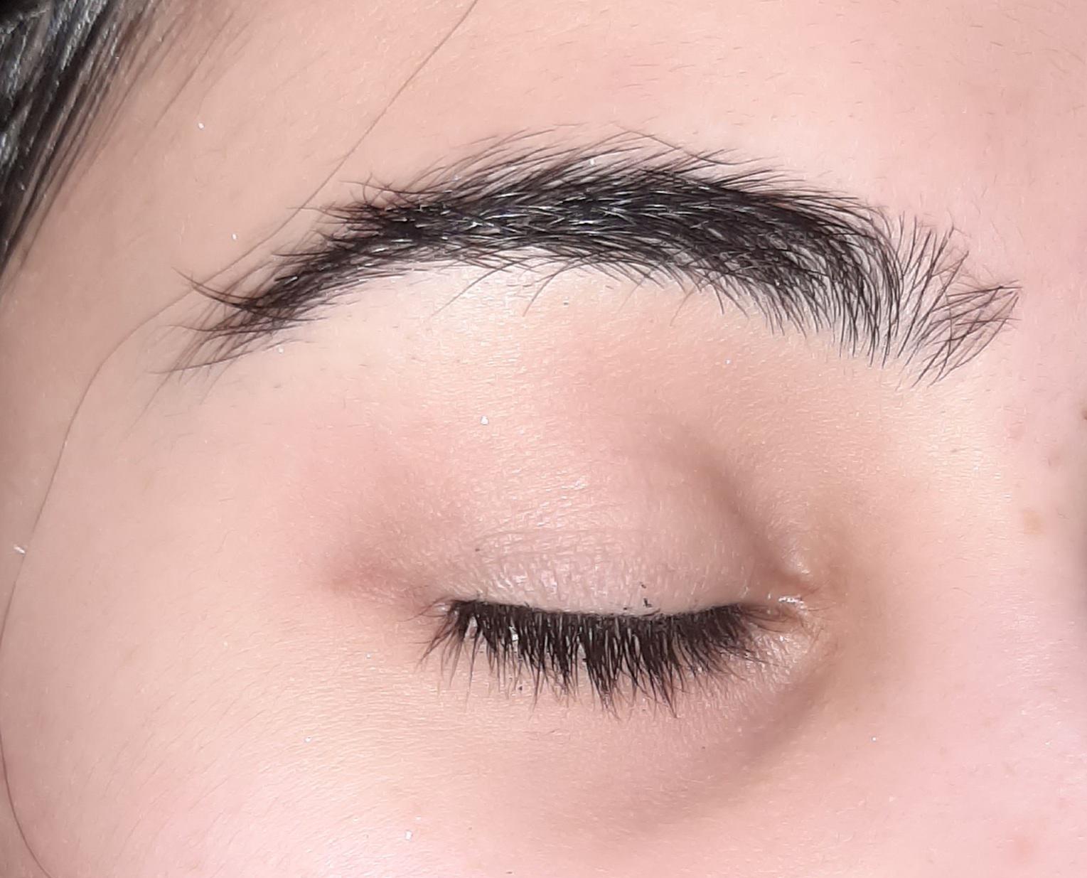 Irritation on skin of eye's outer corner r/tretinoin