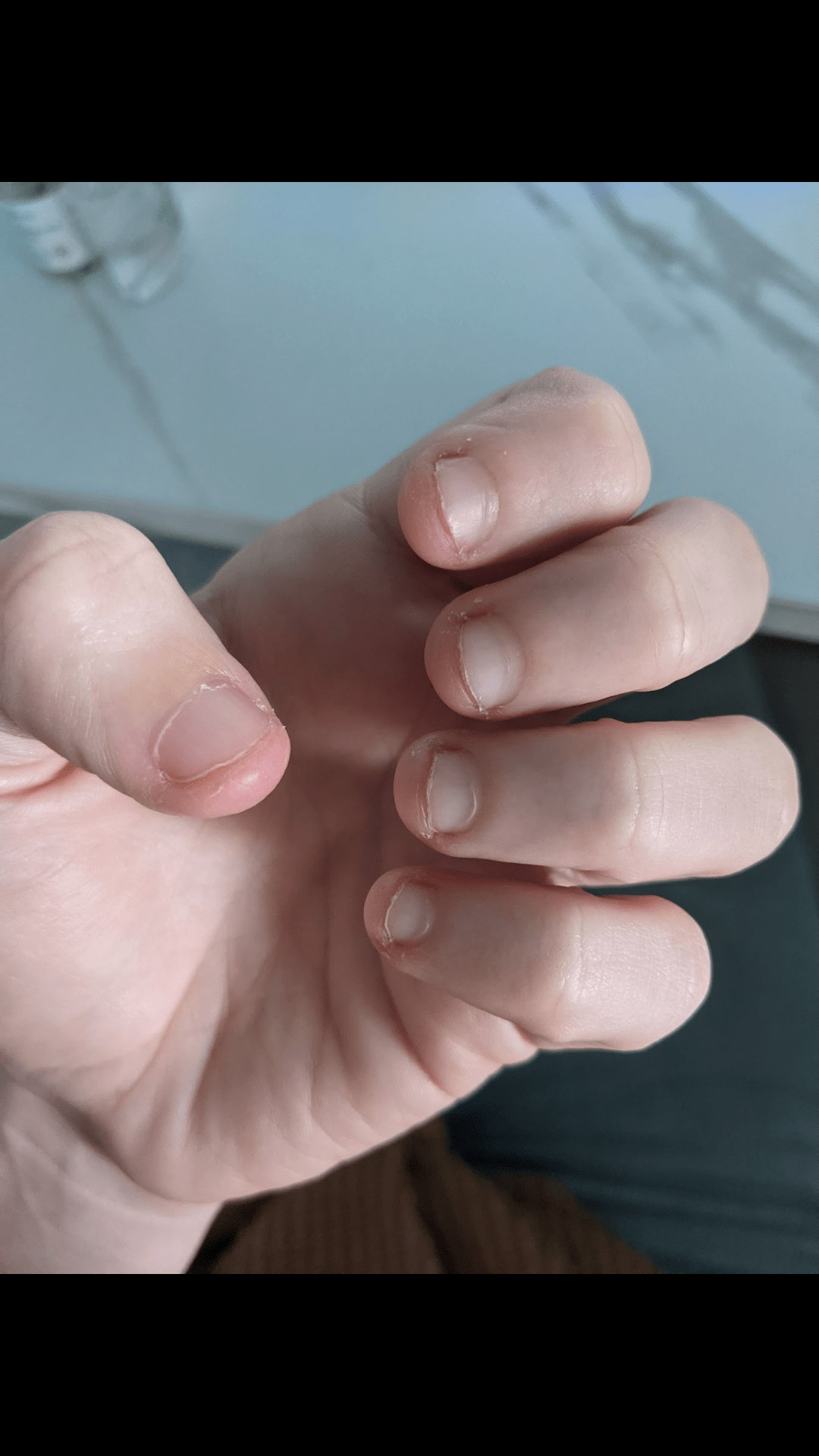 New nail growth progress record! nailbiting