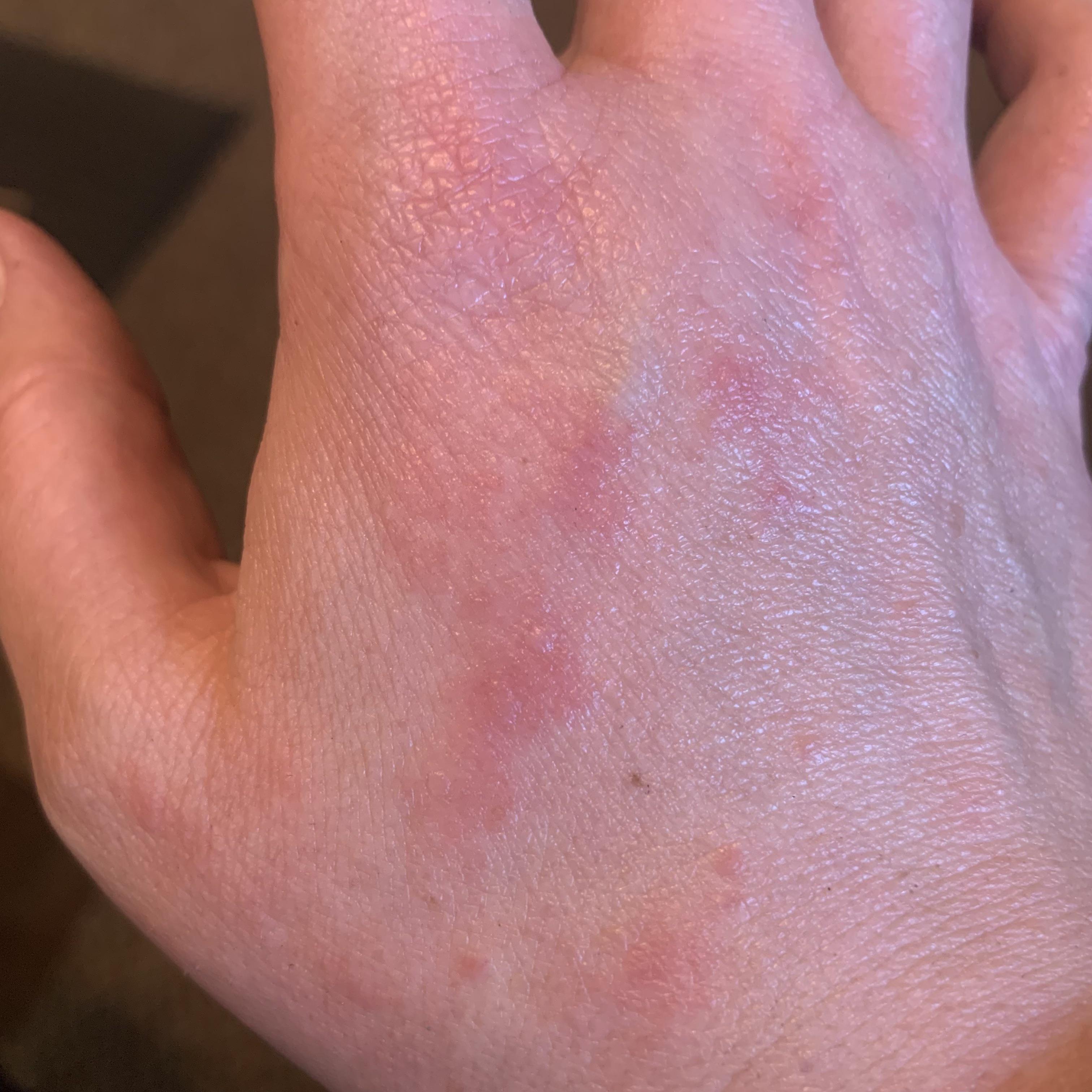 Hoping for help identifying this rash on my hand. It itches unless I