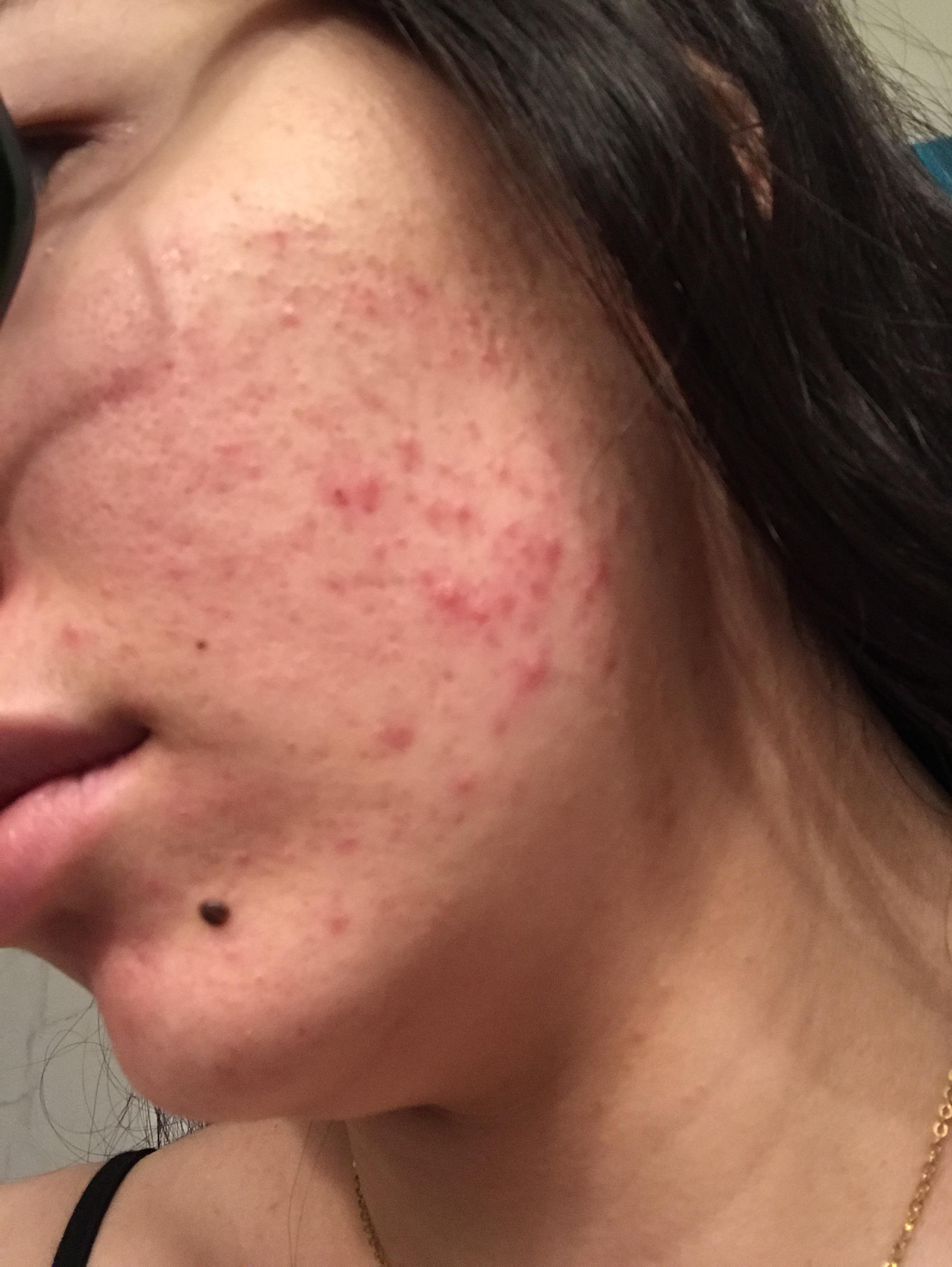 Persistent red acne on and around right cheek area and jaw