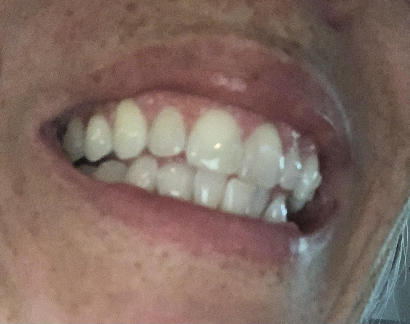 Grey Tooth? r/Invisalign