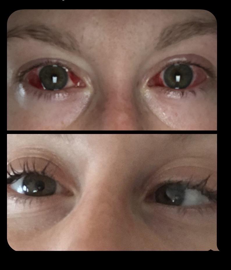 131 best r/strabismus images on Pholder 8 weeks post op bilateral