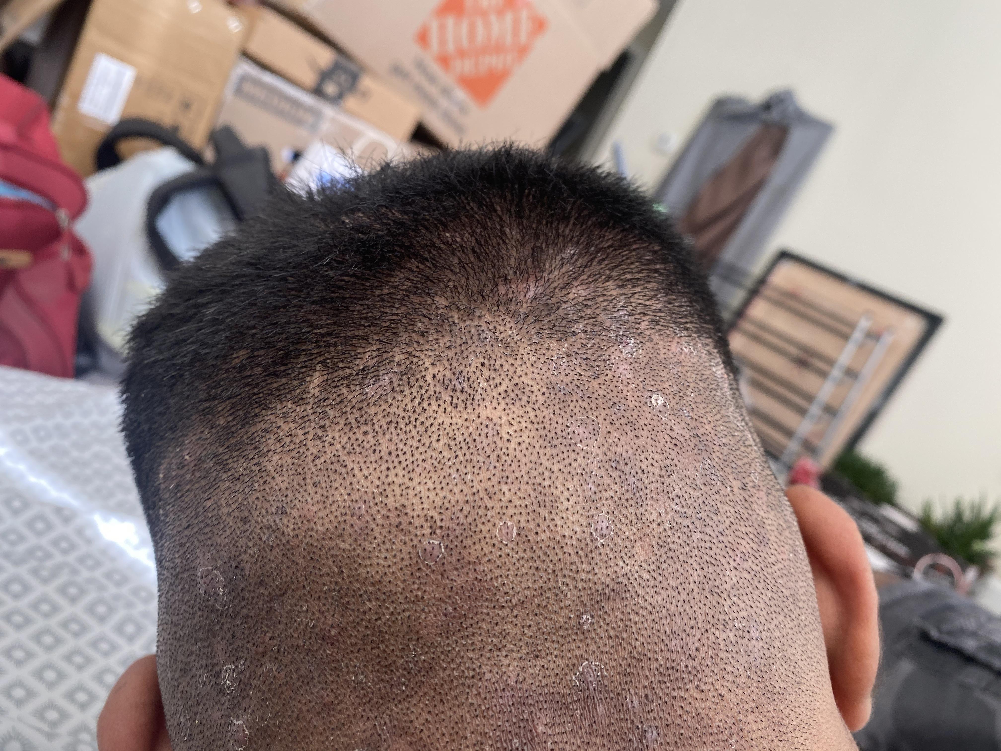 Scalp has pimples so made a aero hair cut . Is this barbers rash? r
