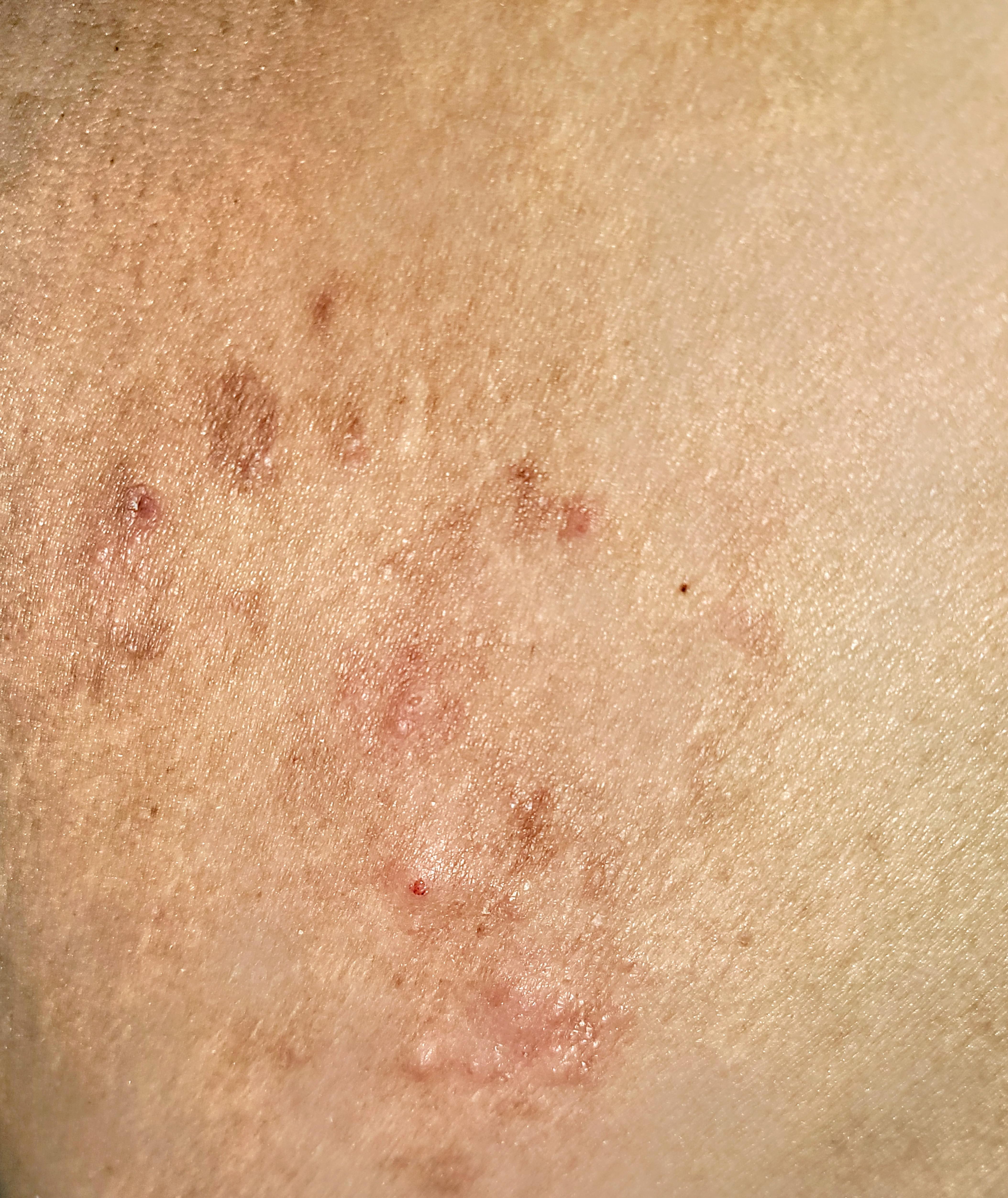 Eczema? They're itchy and came out of nowhere, at least imo. This is