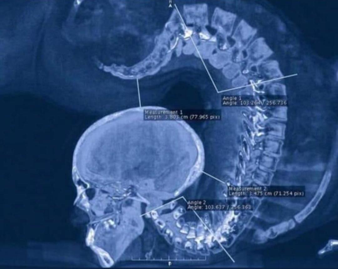 XRay of a gymnast doing a floor exercise looks like a Mortal Combat