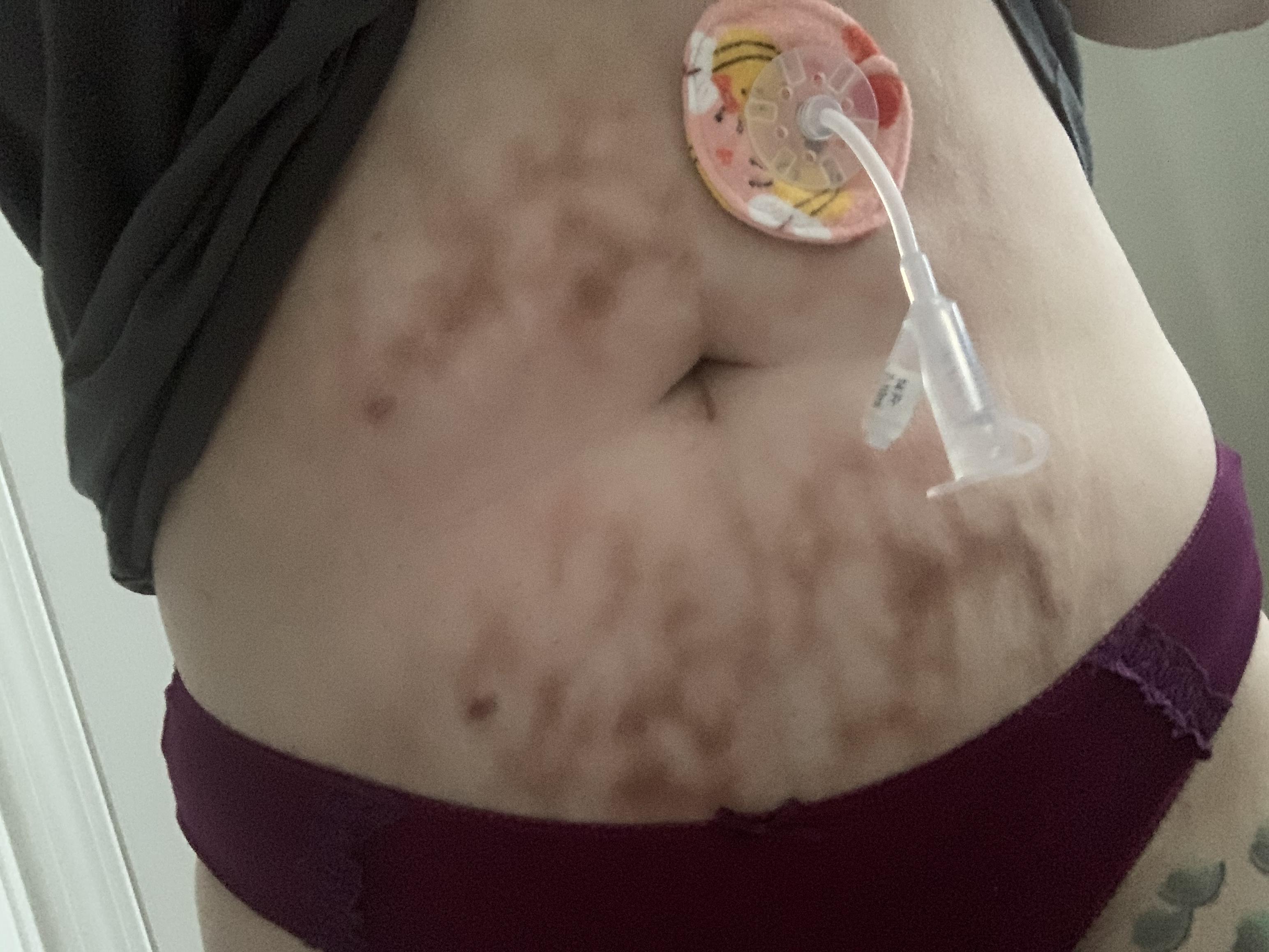 TW Bare stomach and feeding tube. Does anyone else get burns like