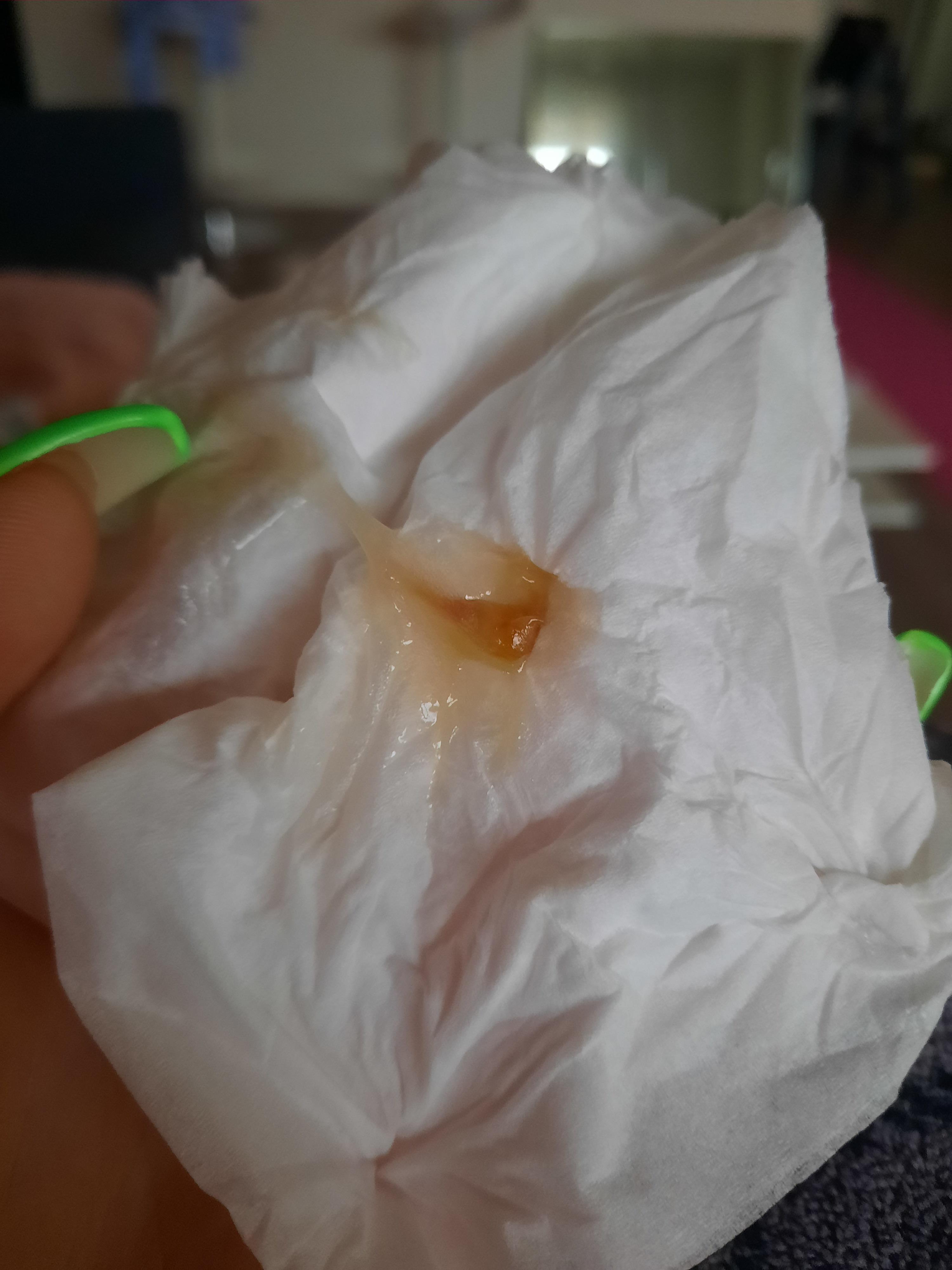 Orange mucus coming from very painful sinuses. Cheek swollen and all