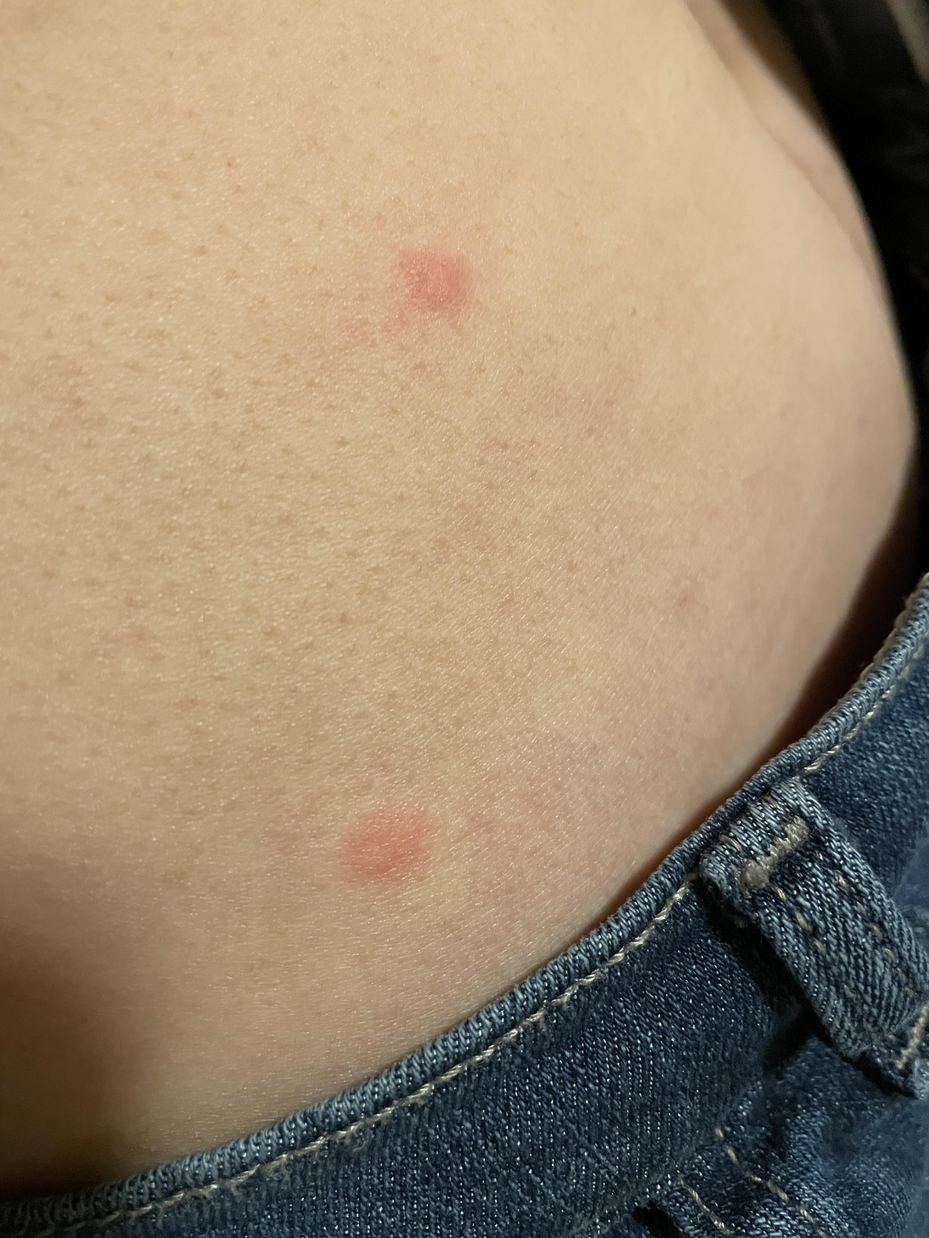 are these stress hives or bed bug bites? r/bugbite
