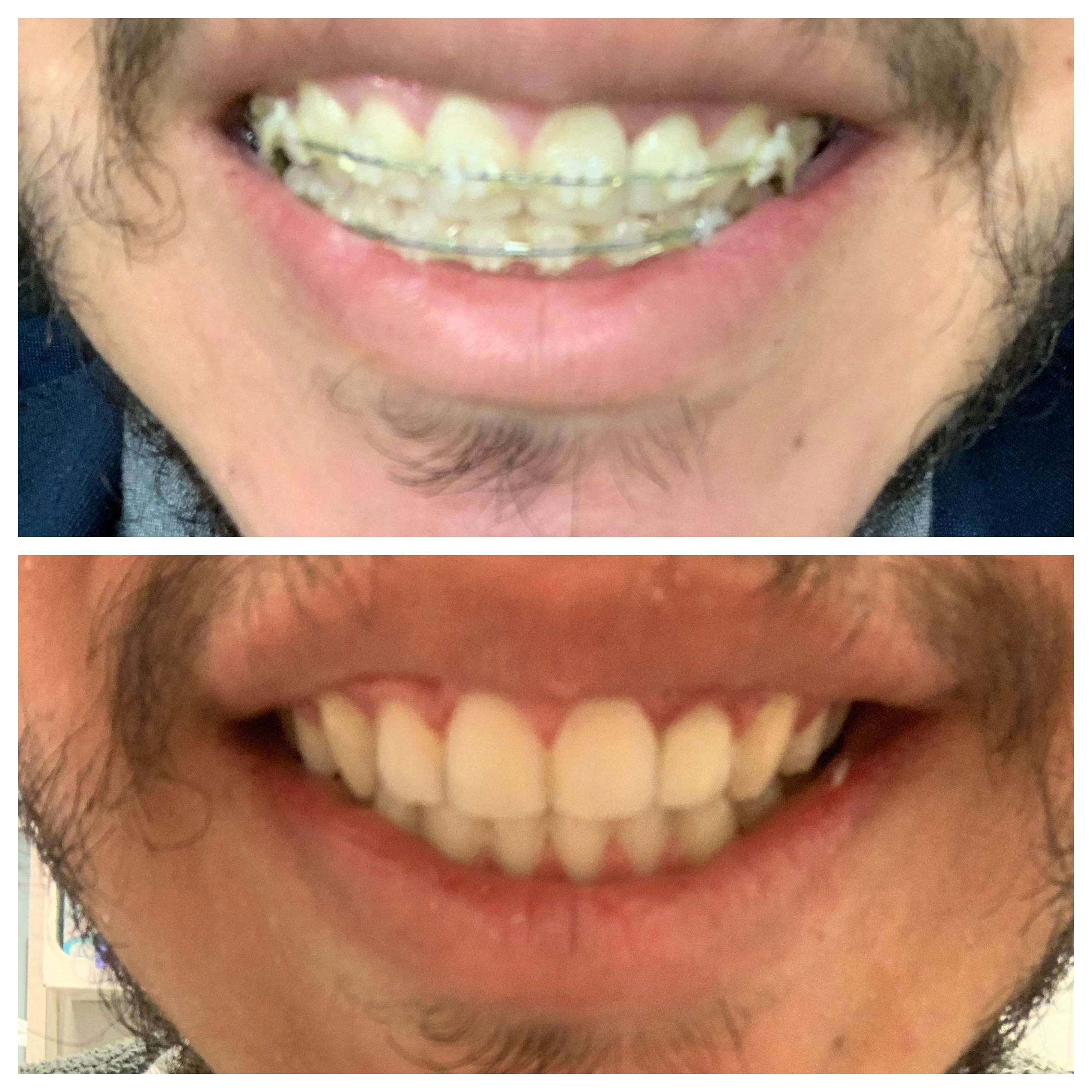 It’s never too late to get braces! On at 26, off at 27. r/braces