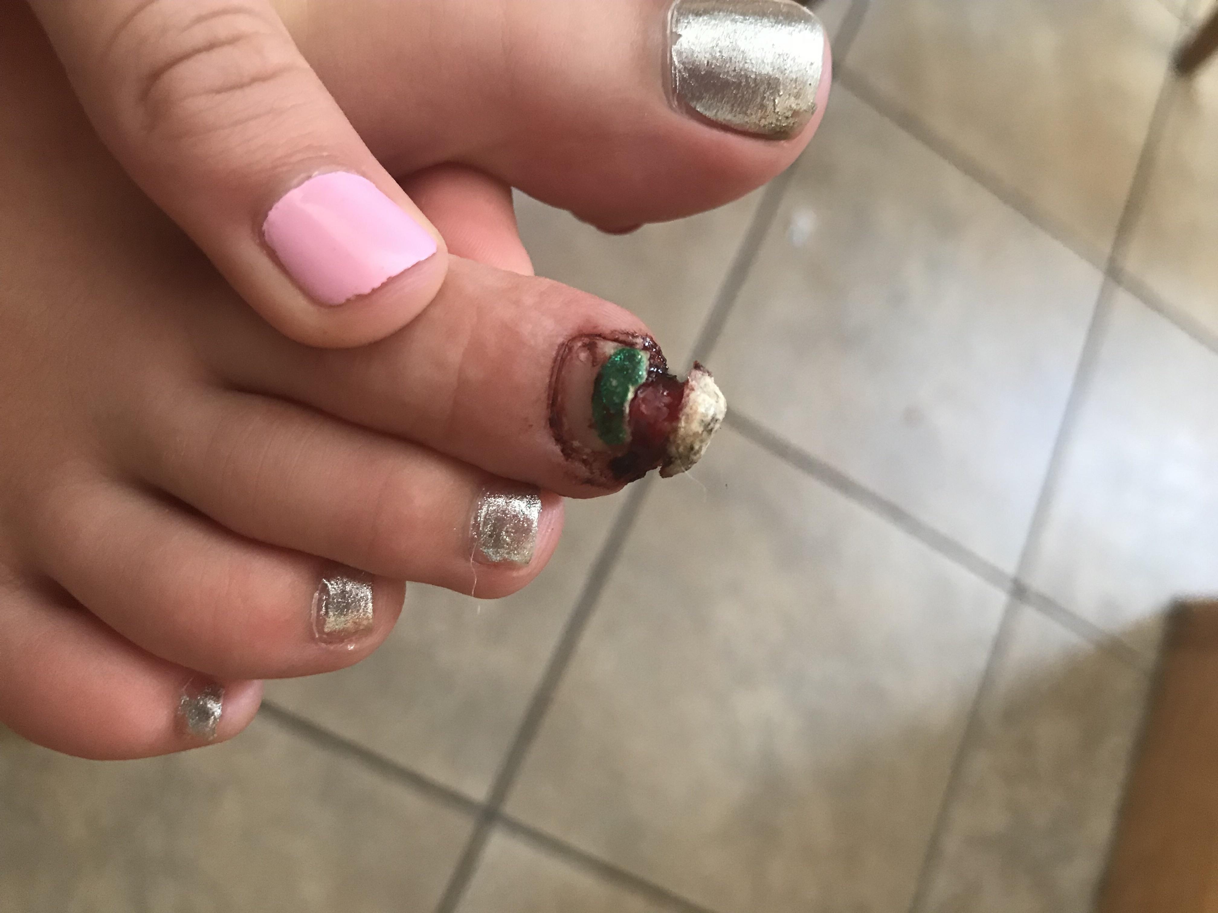 Seed Wart Pictures imgpoof