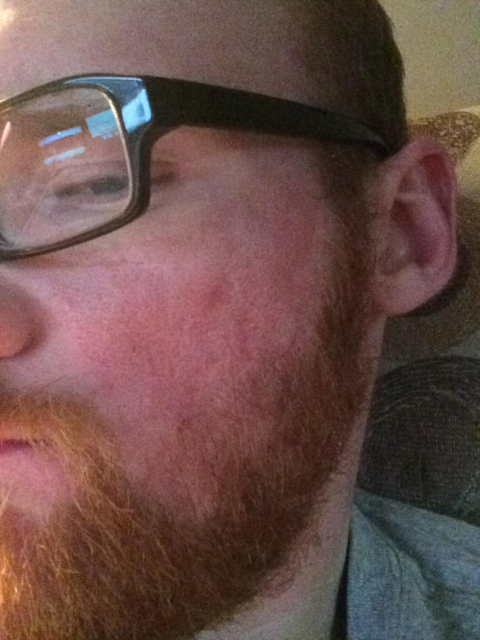 Bad PIE from Acne Anything I can do? r/SkincareAddiction