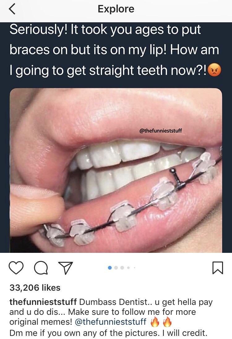 When he puts the braces on your lips 😡😤🤣😎