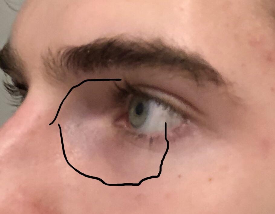 Tretinoin under eyes tretinoin