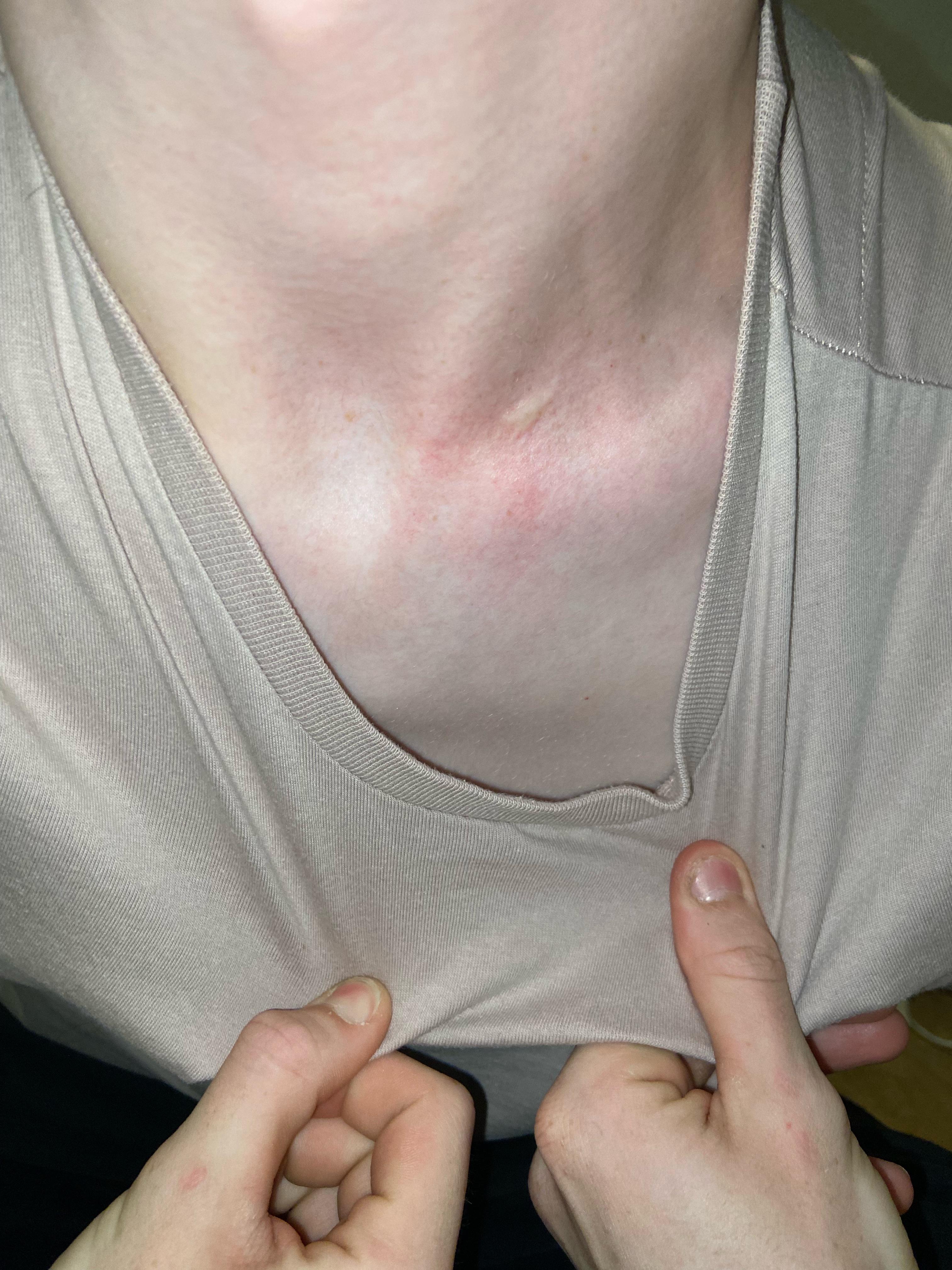 Bone Bone Lump Near Collar