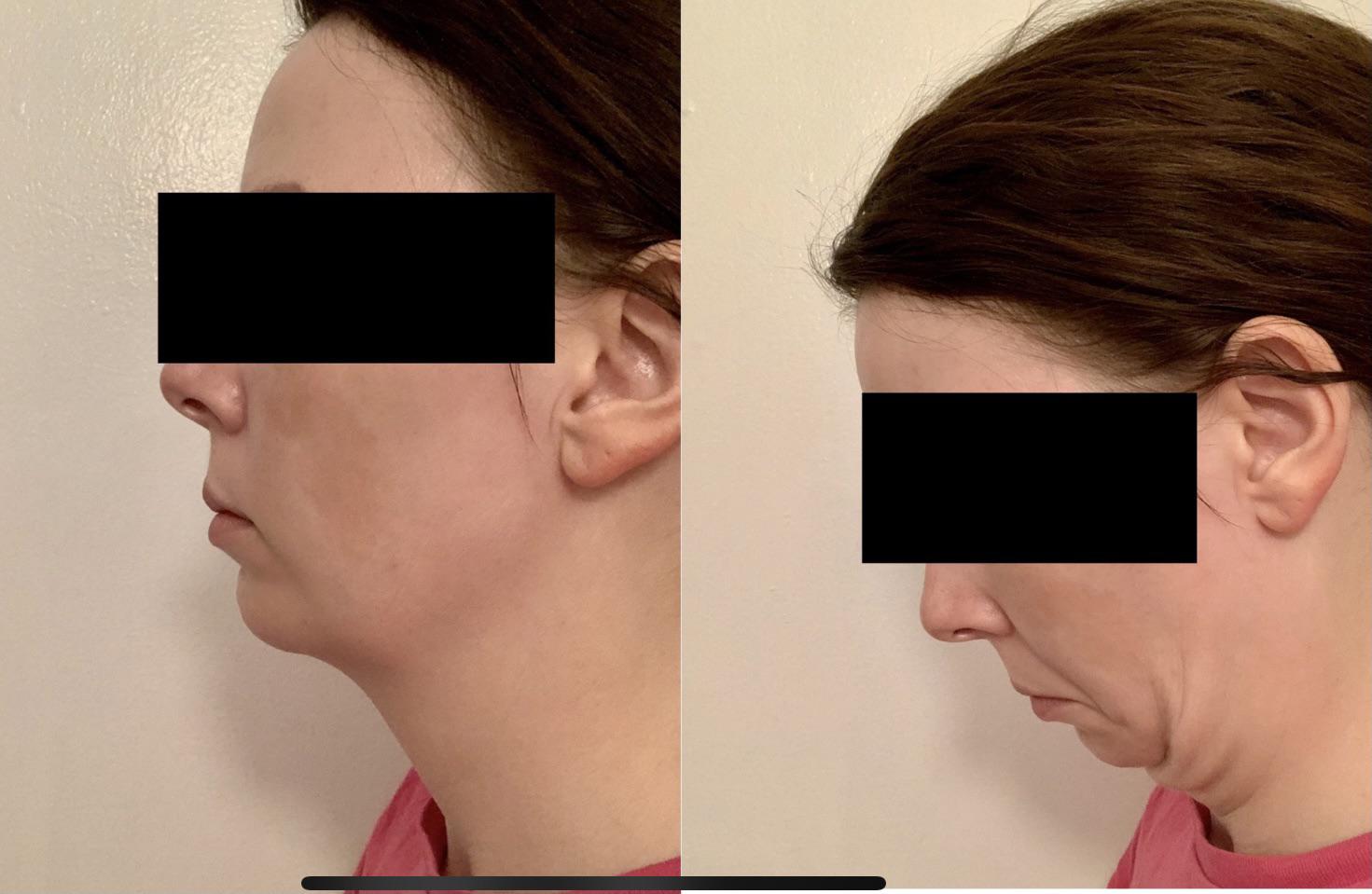 Had disappointing chin lipo results, now looking to augment with an
