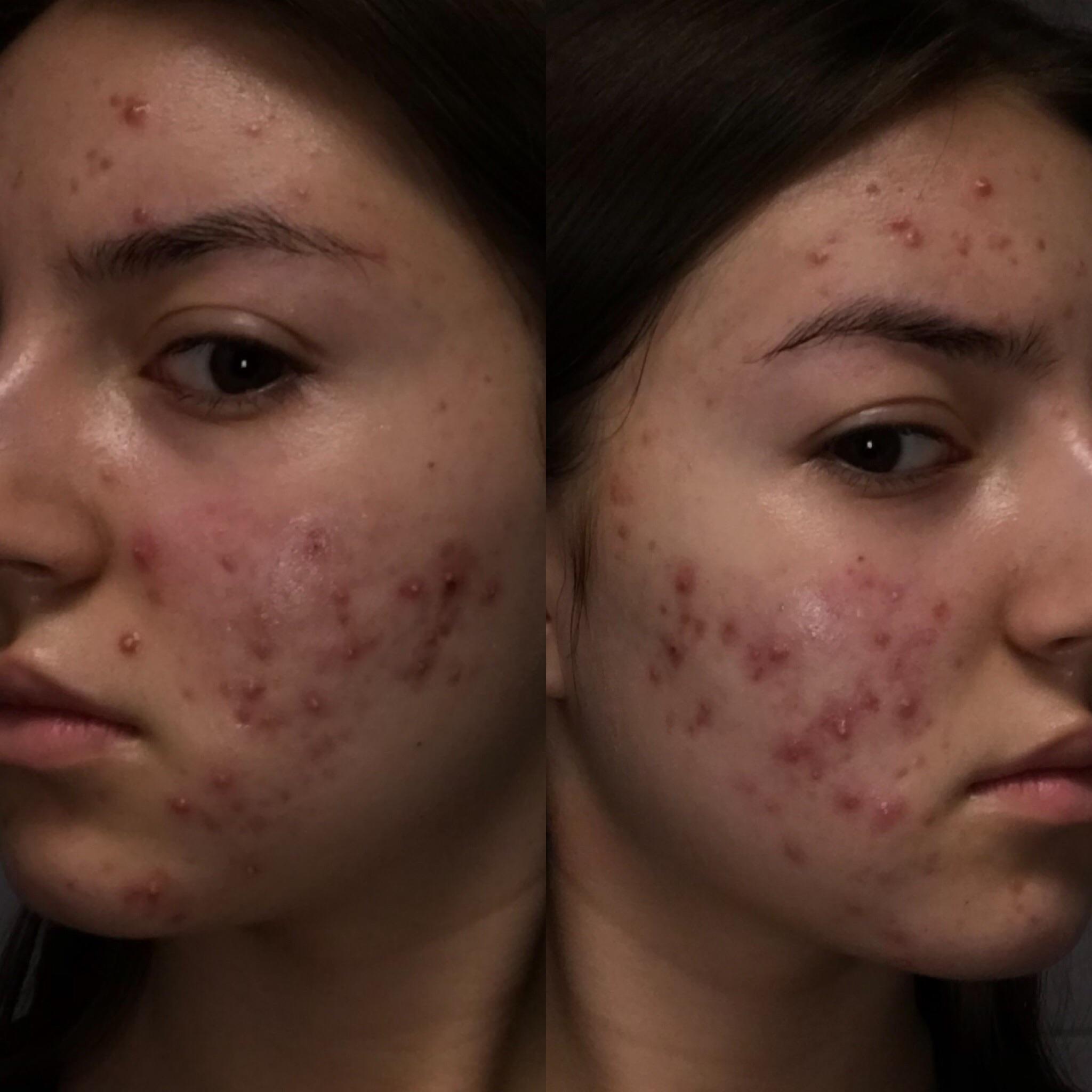 Body acne solutions? acne