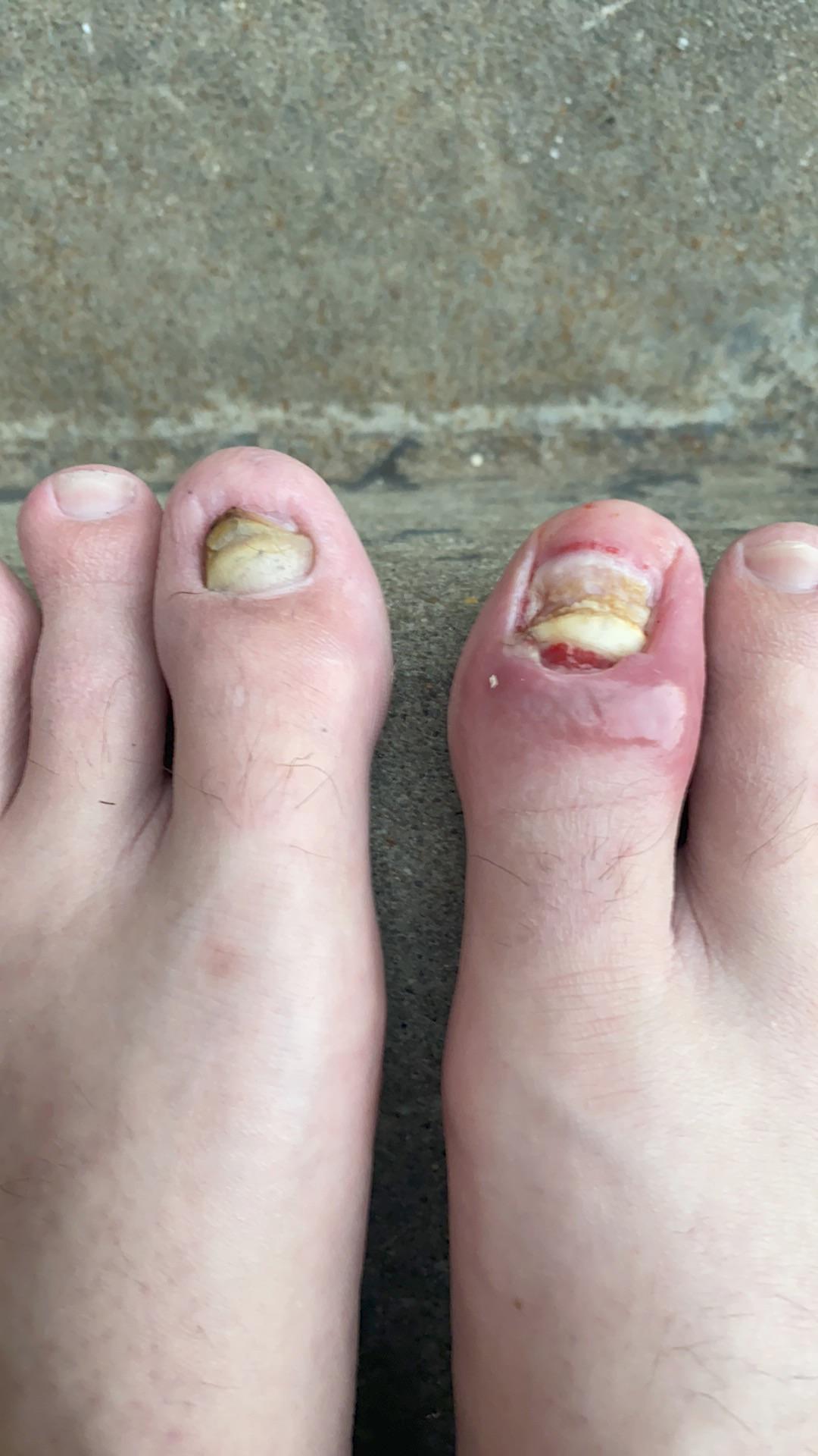 Both of my big toenails are (were?) ingrown. The one on the right JUST