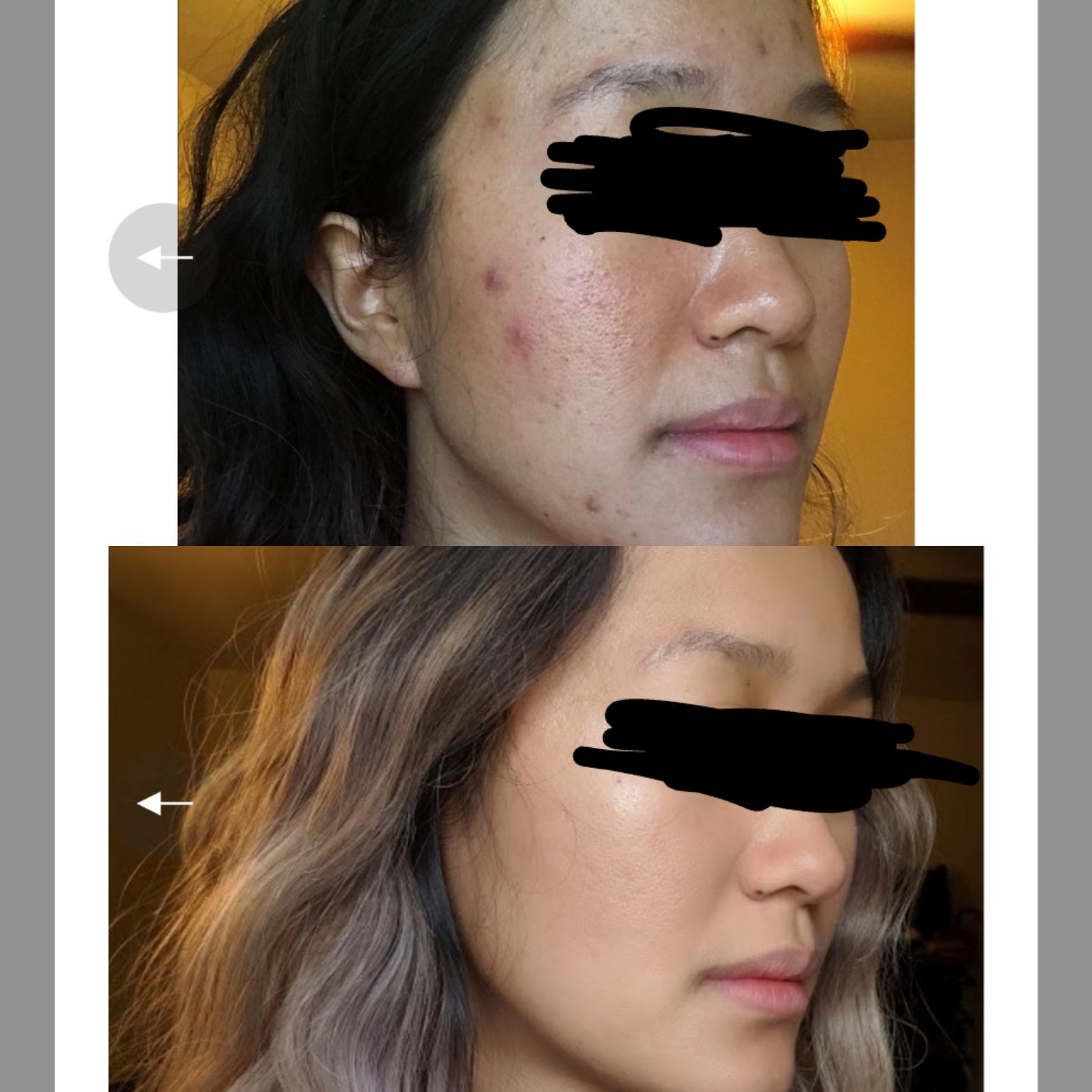 After 1 year of being on spironolactone! r/acne