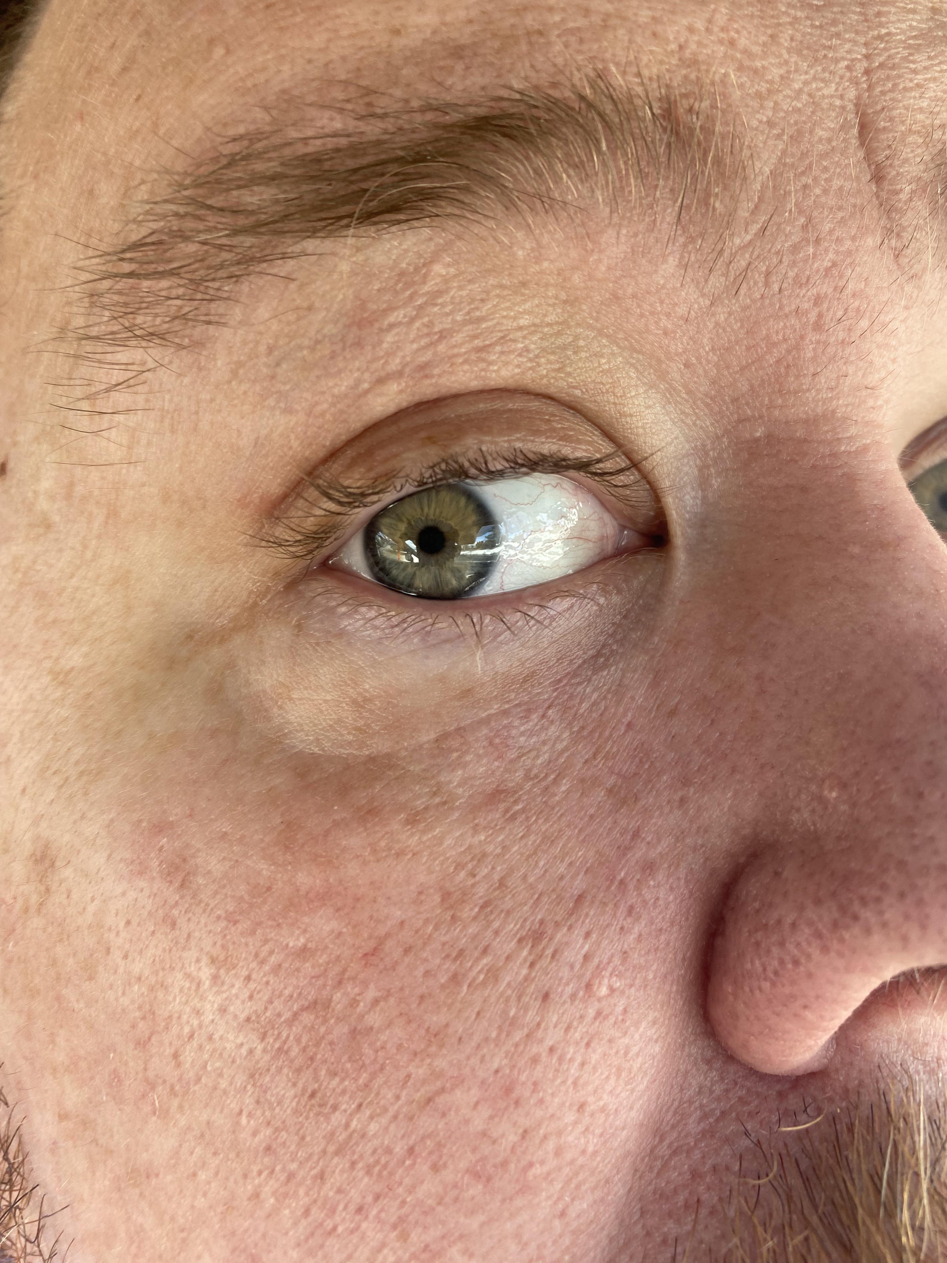 Can eye strain cause swollen lower eyelid?? Please help. r