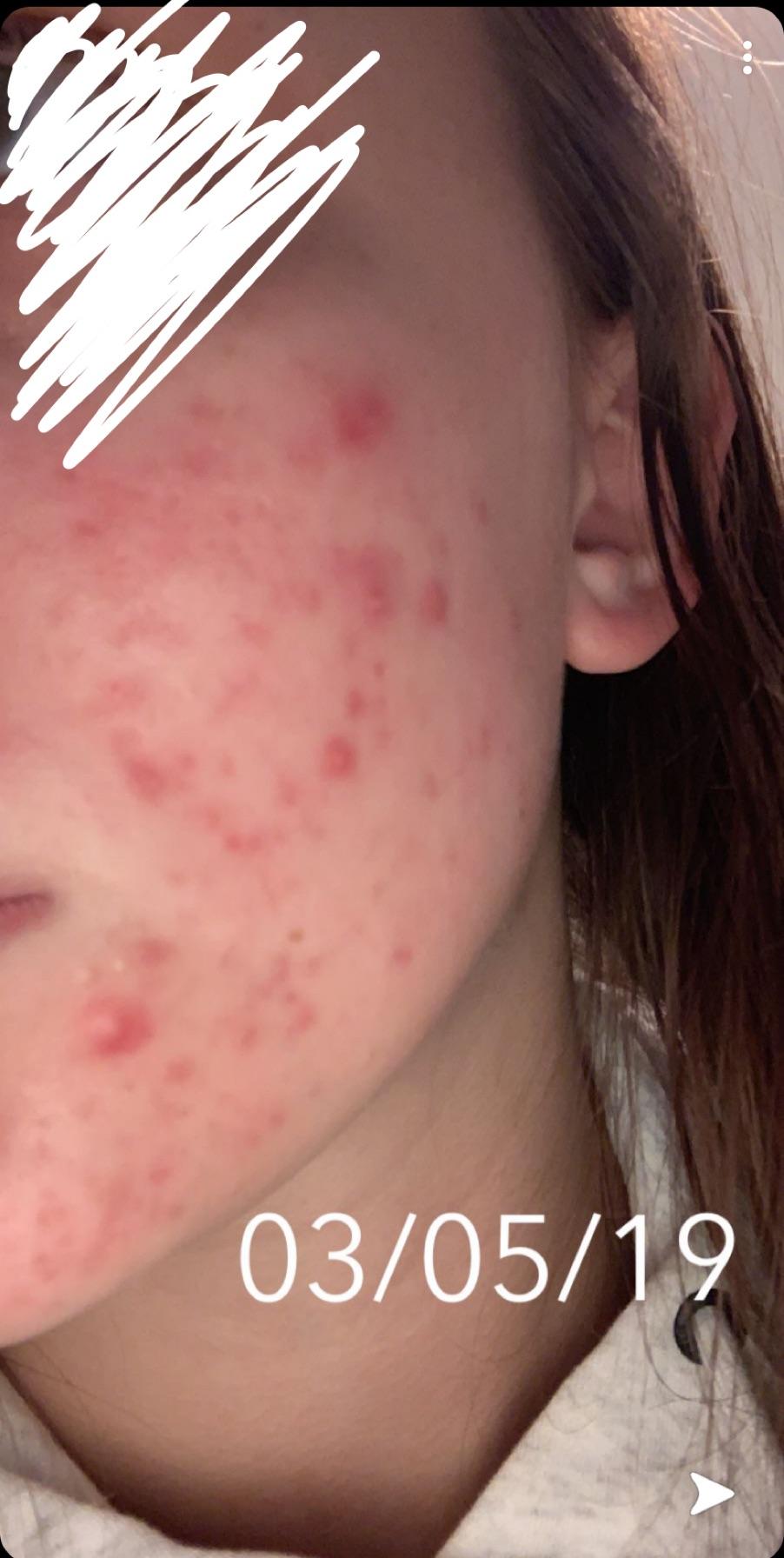 [routine help] my acne is ruining my life and i don’t know what else to