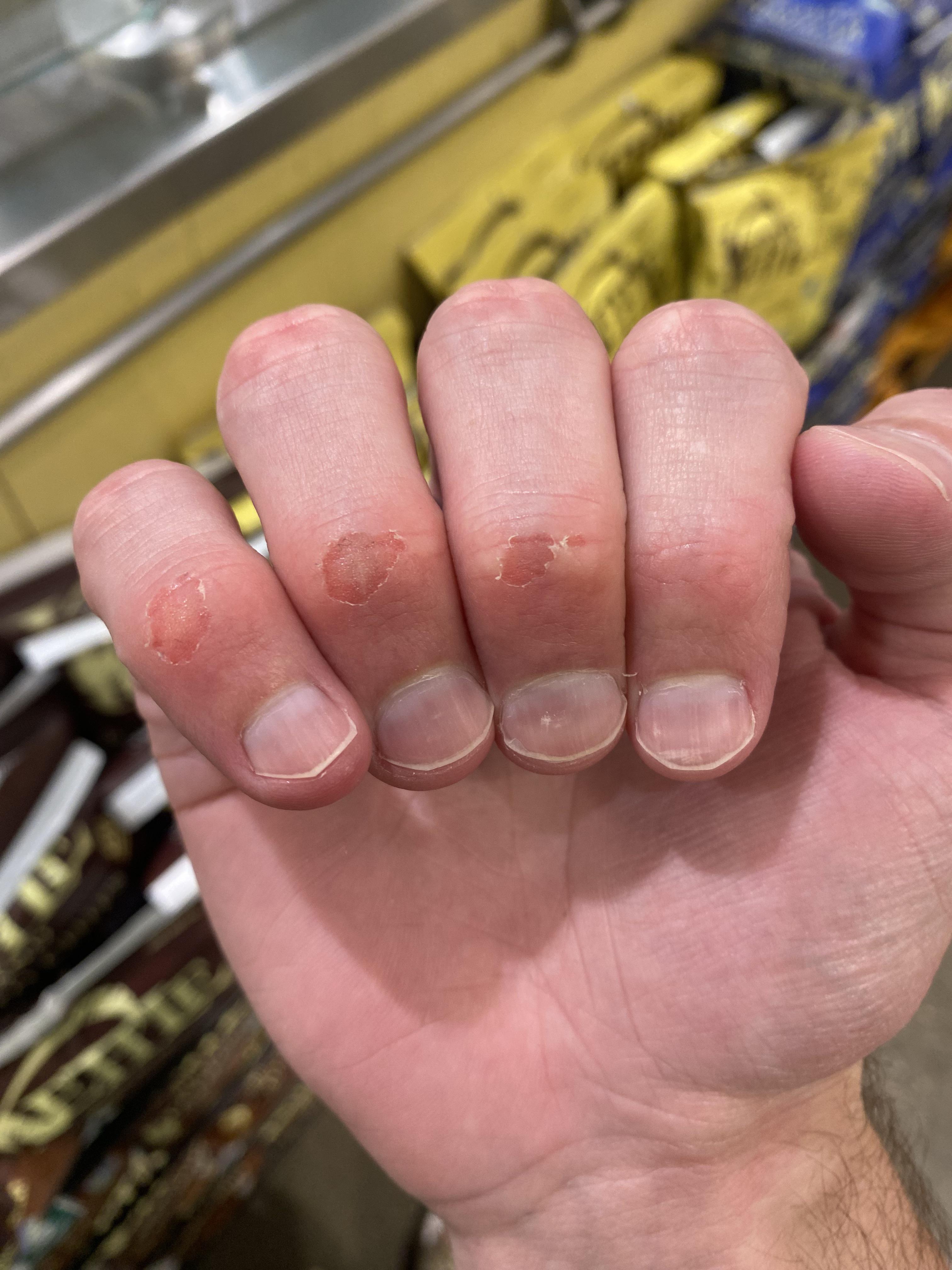 What is the best way to cover these and how do I stop doing this to