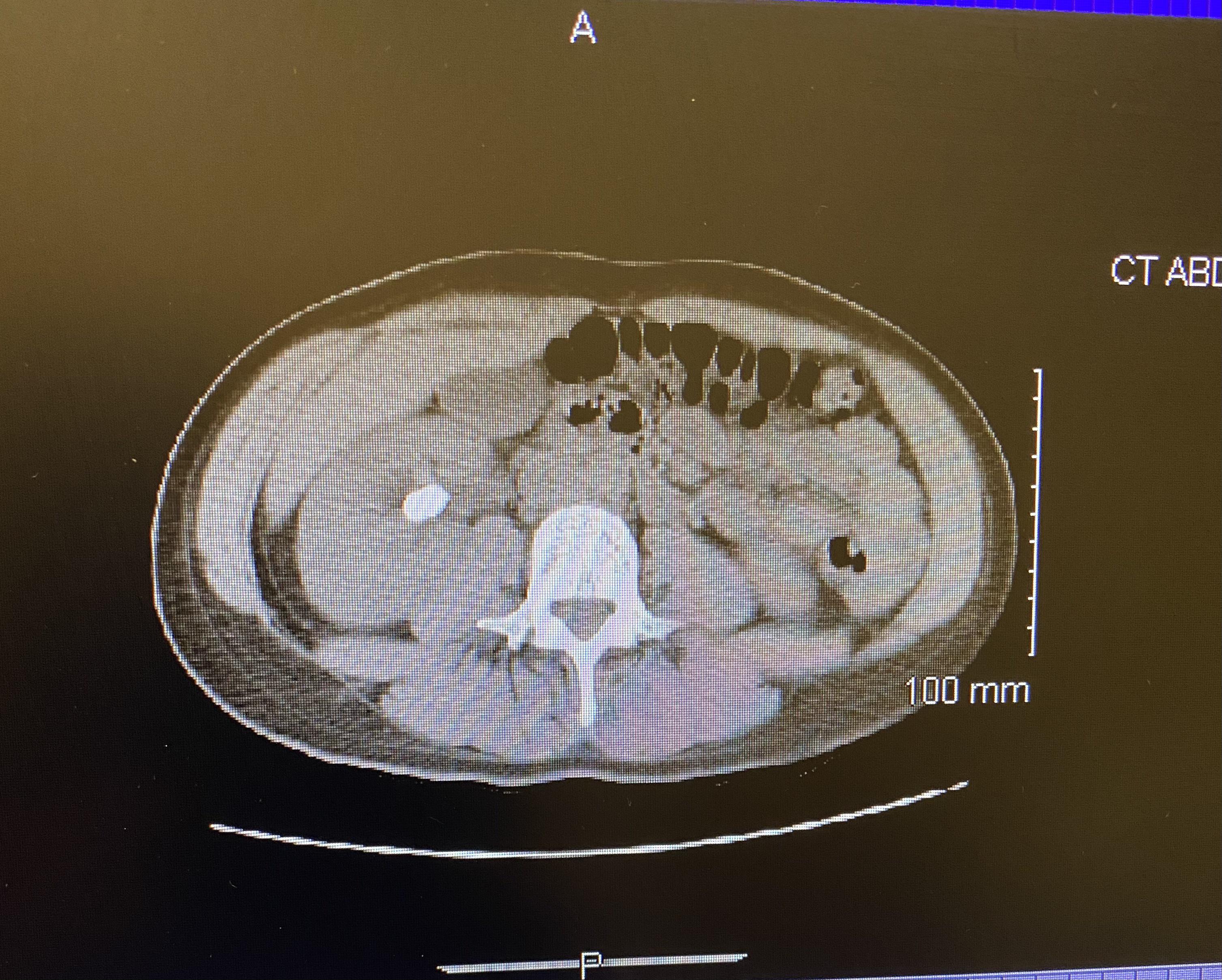 Night time flank / URQ pain KidneyStones