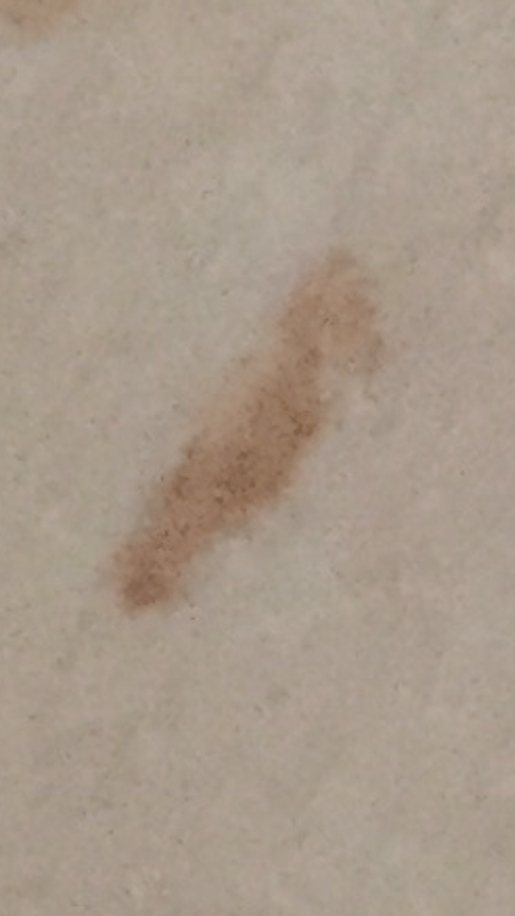 Sudden Long Skinny Brown StreakLike "Moles" on My Back r/DiagnoseMe