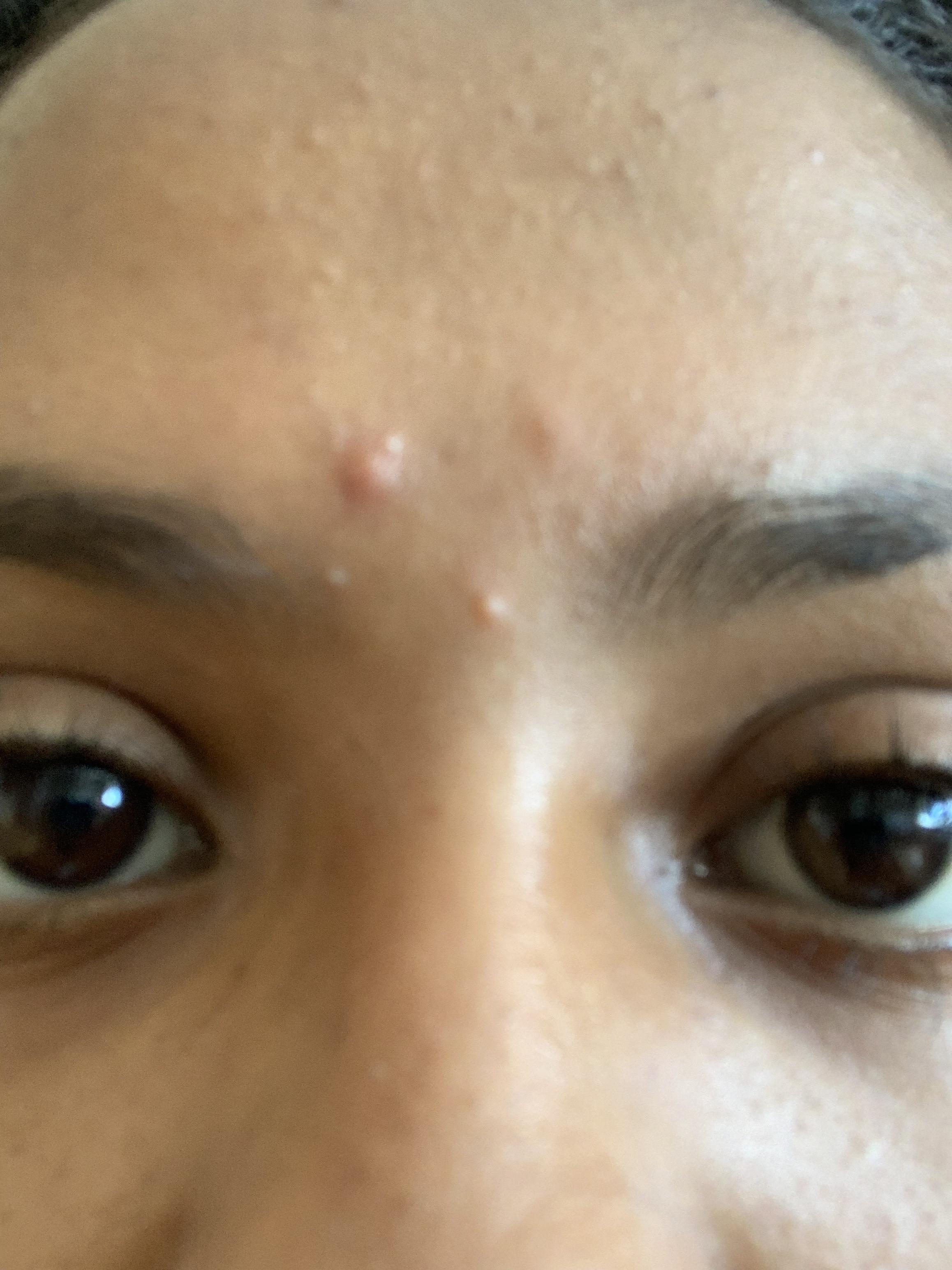 How can I get rid of this pimple in between my eyebrow? Everytime I get