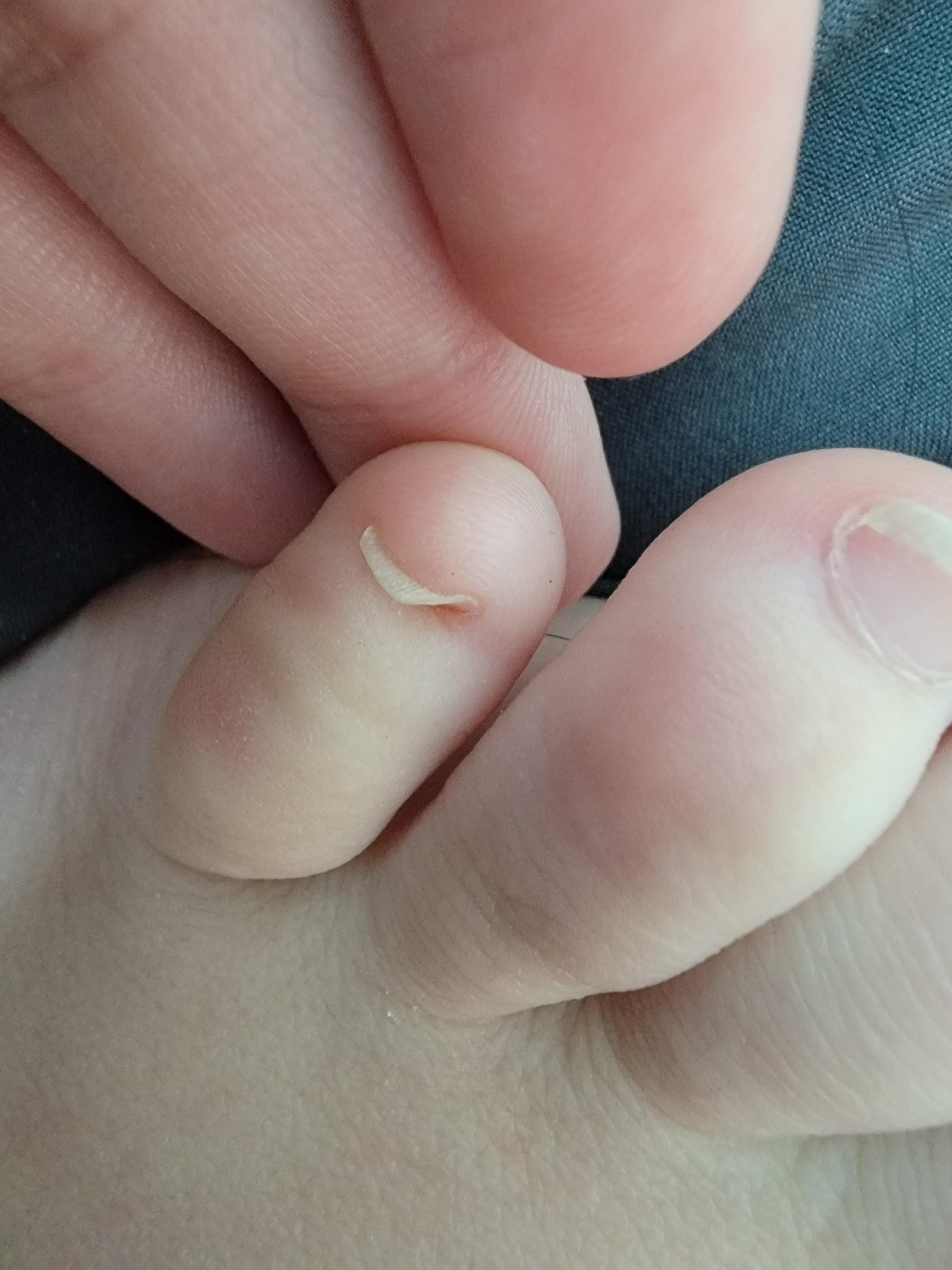 Why do my pinky toes do this? Toenail grows up r/medical