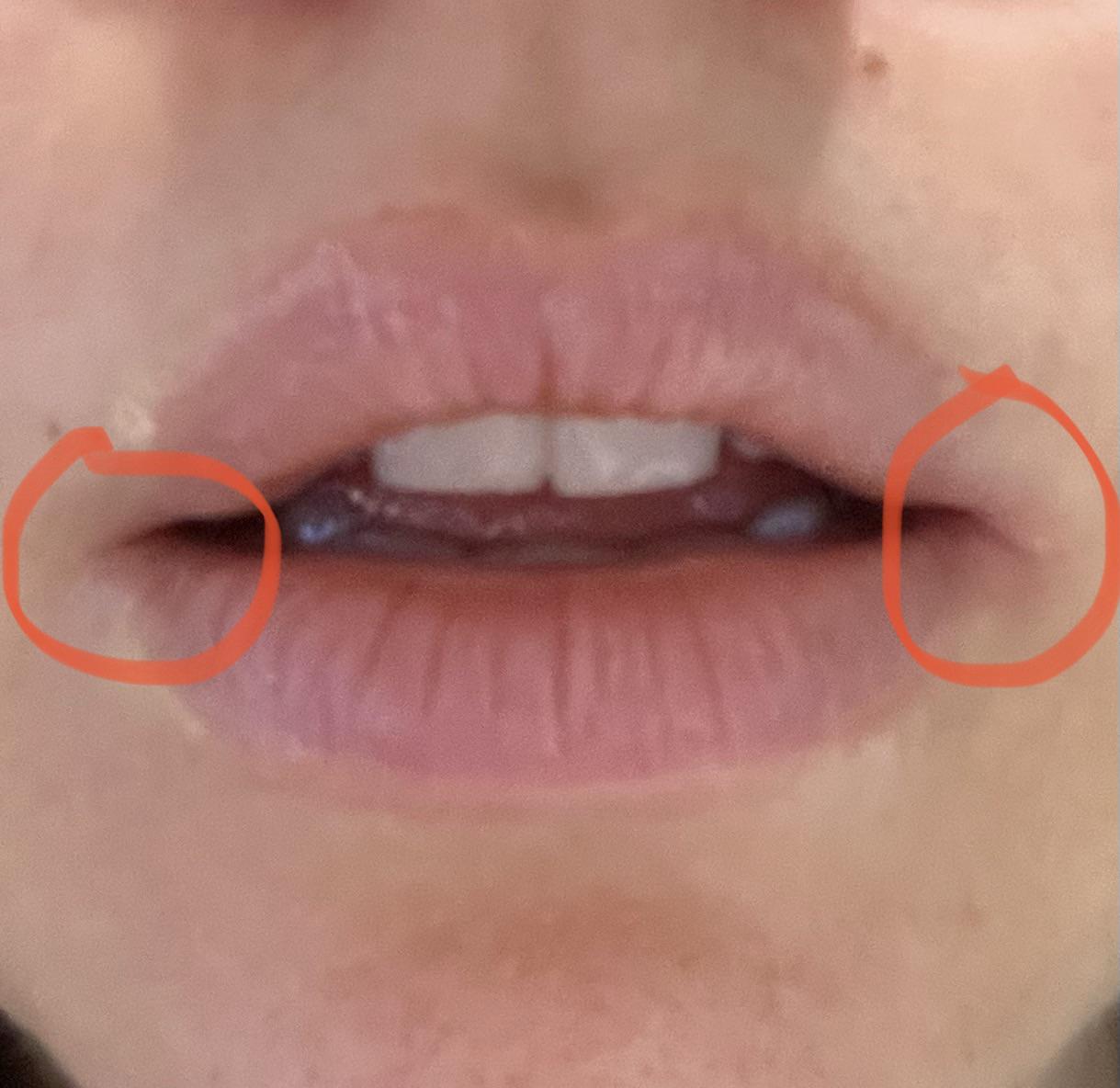 Suddenly having a recurring issue with my mouth corners cracking