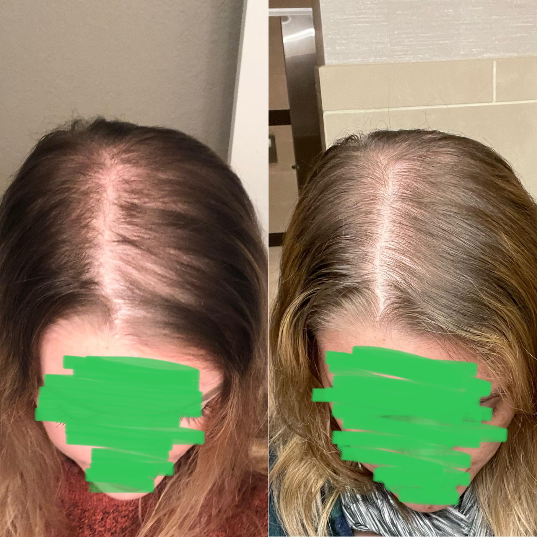 Vellus hair shedding due to minoxidil?... FemaleHairLoss