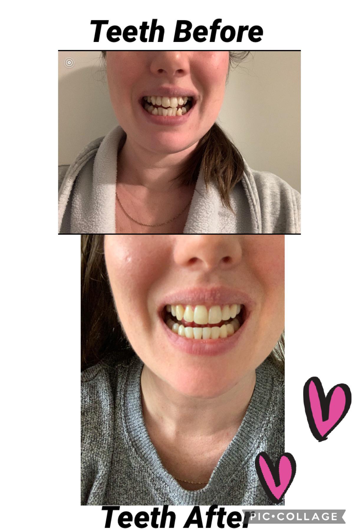 72 trays downs! Got attachments off. Now onto night time retainer with