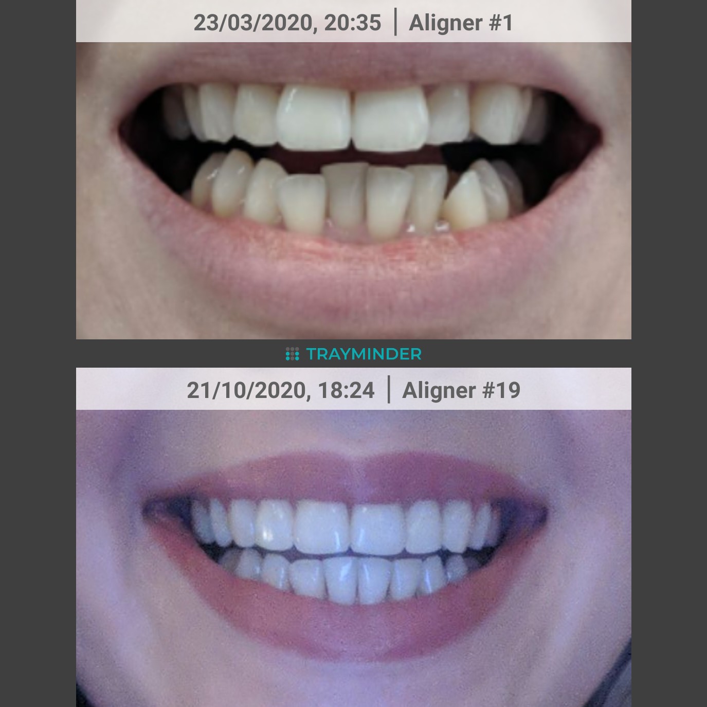 And she's done ! 😊 Invisalign lite with refinements (7 months) r