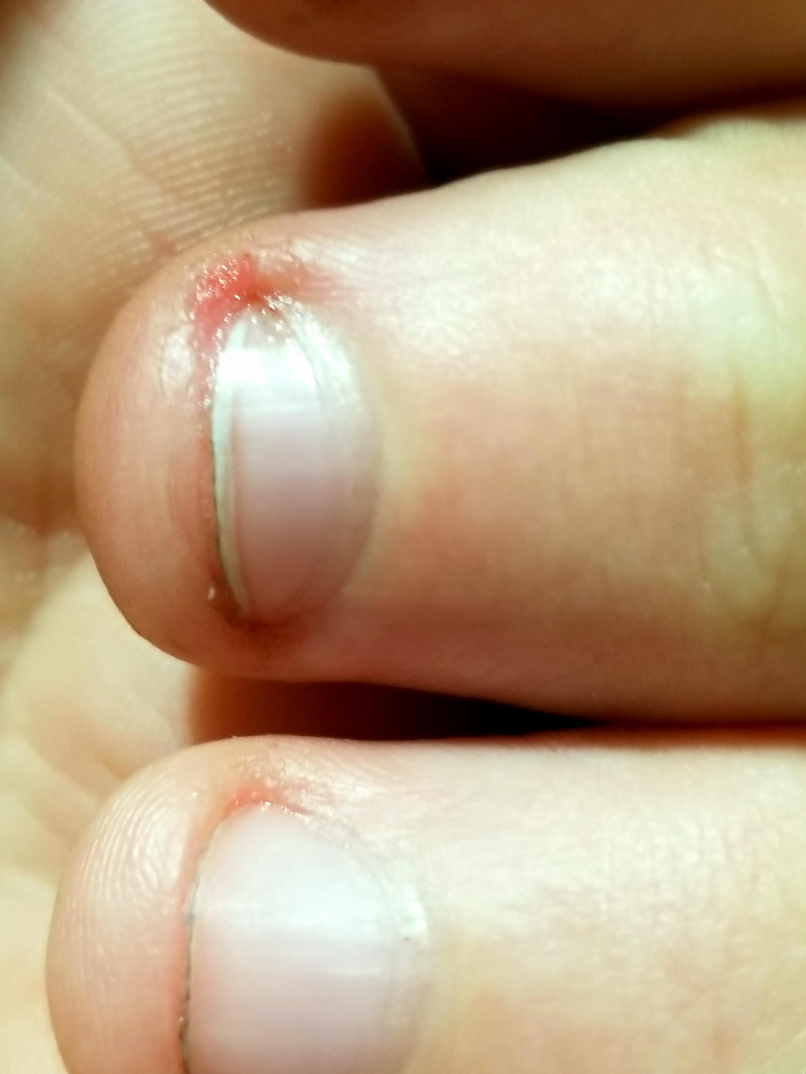 I'm a few weeks bite free for the first time in my life! No skin or