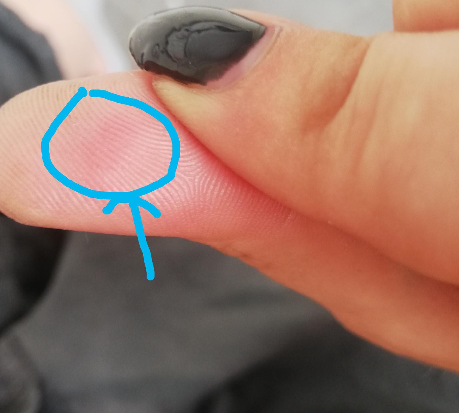 painful red lump on thumb. Its barely noticable looking at it but iys painful enough on applied
