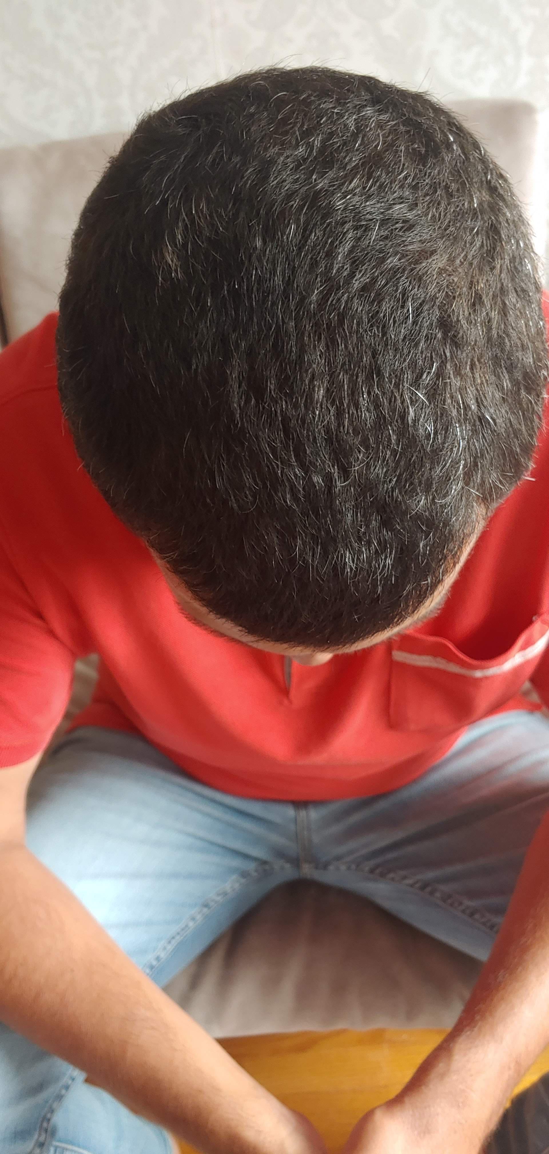 Alopecia areata and allergy testing? alopecia_areata