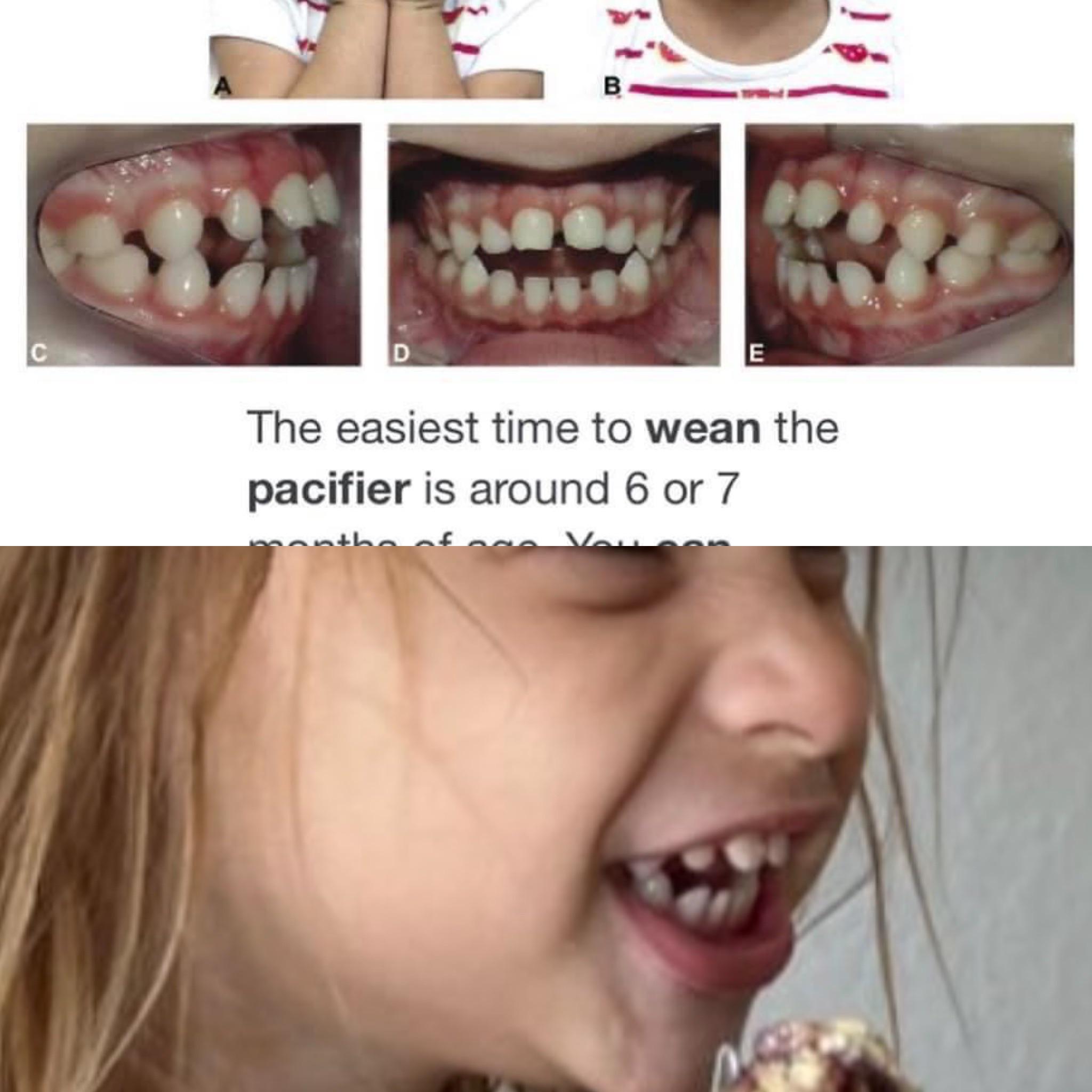 My repost to the pacifier teeth post. John & Ali you are doing nothing