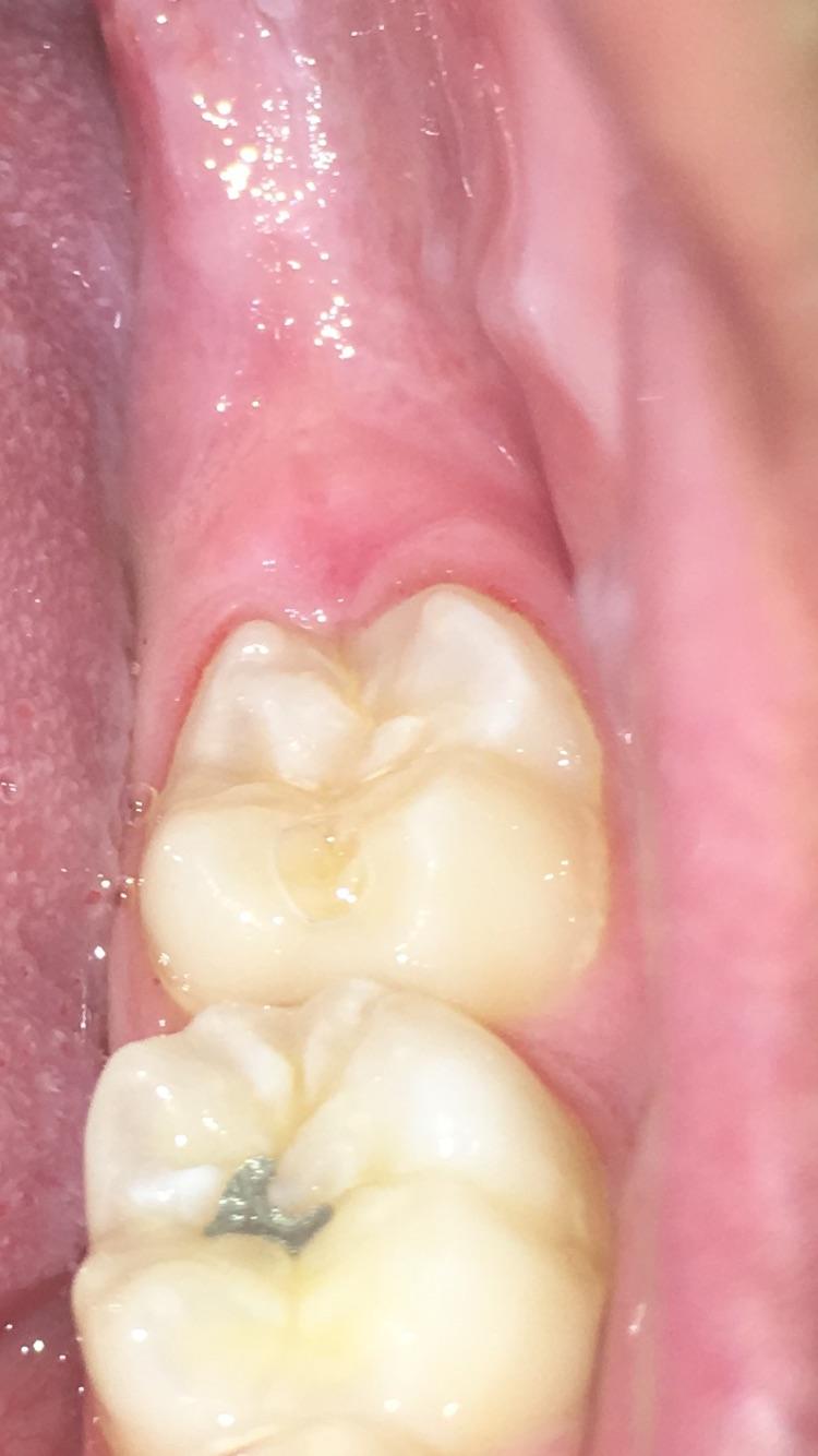 painful gum swollen around wisdom tooth overnight, any help/home
