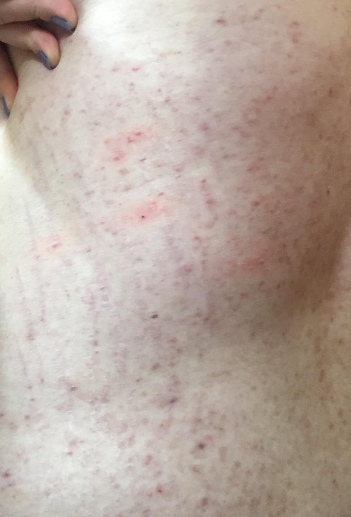 My allergic reaction to Bactrim. I was burning and screaming in pain