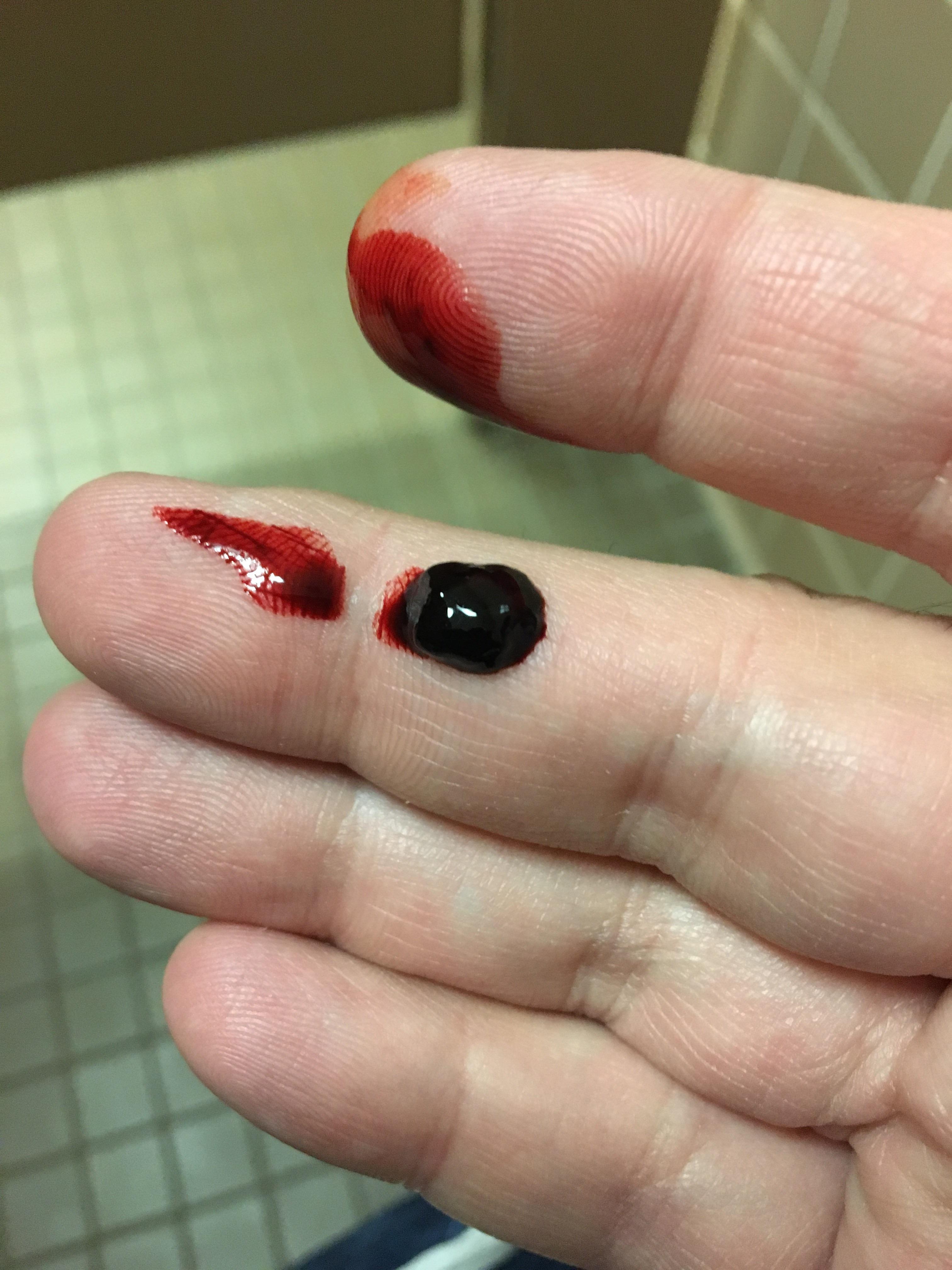 Popped my thrombosed hemorrhoid today popping