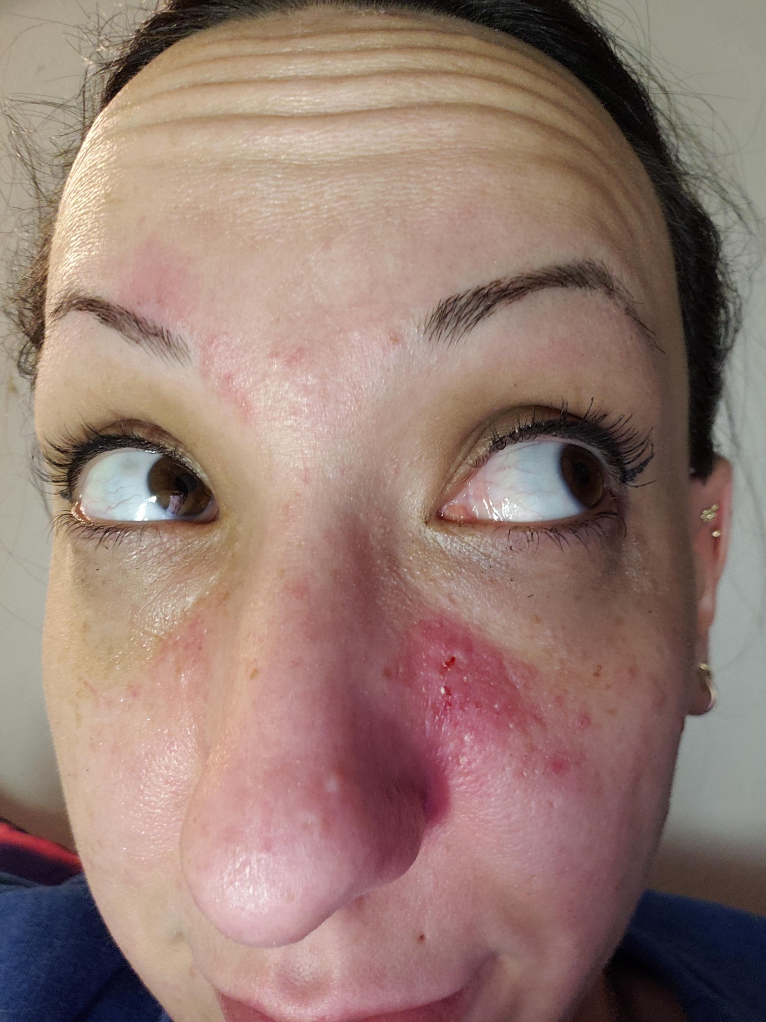 Cystic Acne Hormonal Reddit shearlingwomenbestquality