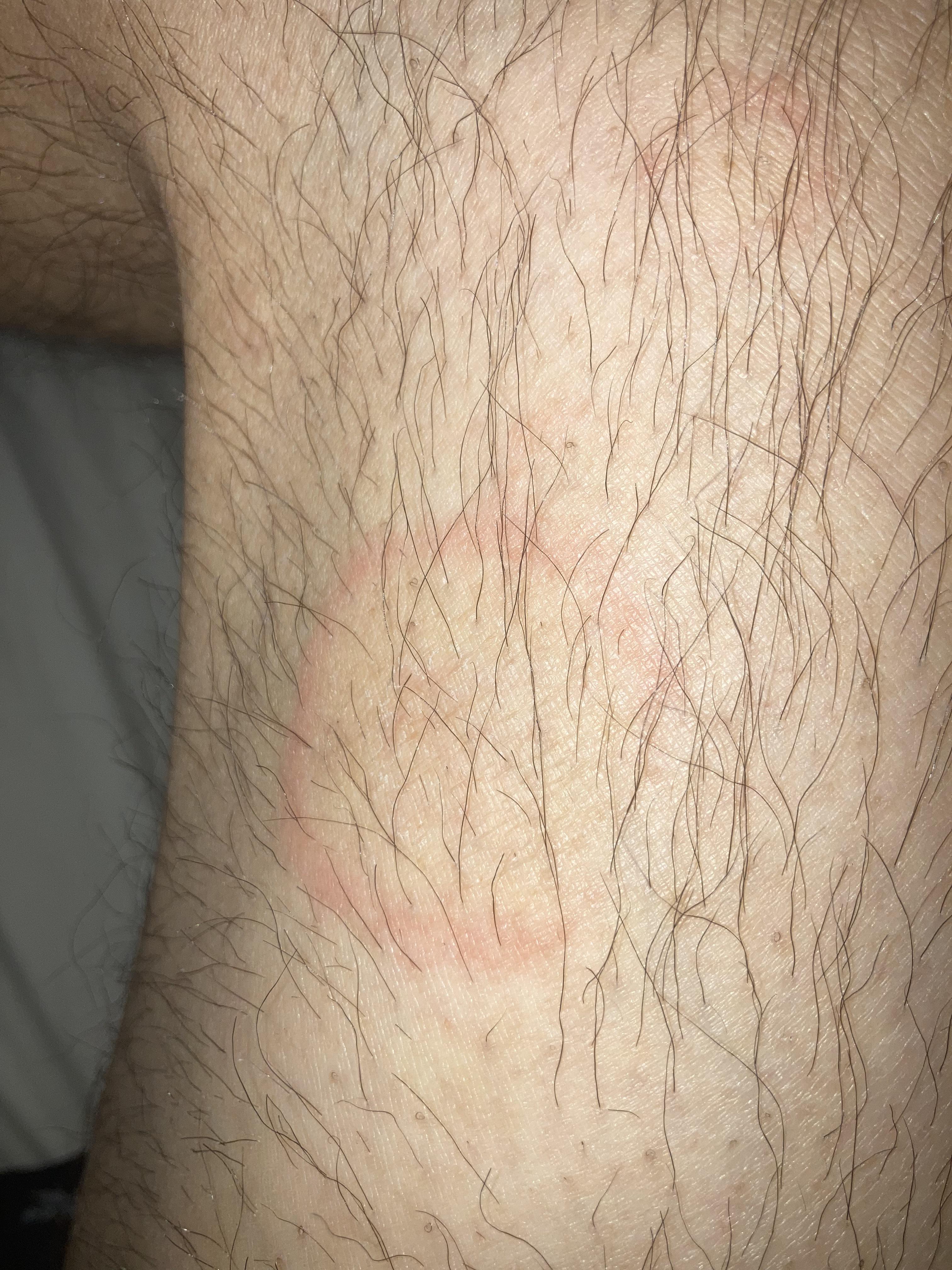 Is this ringworm? ringworm