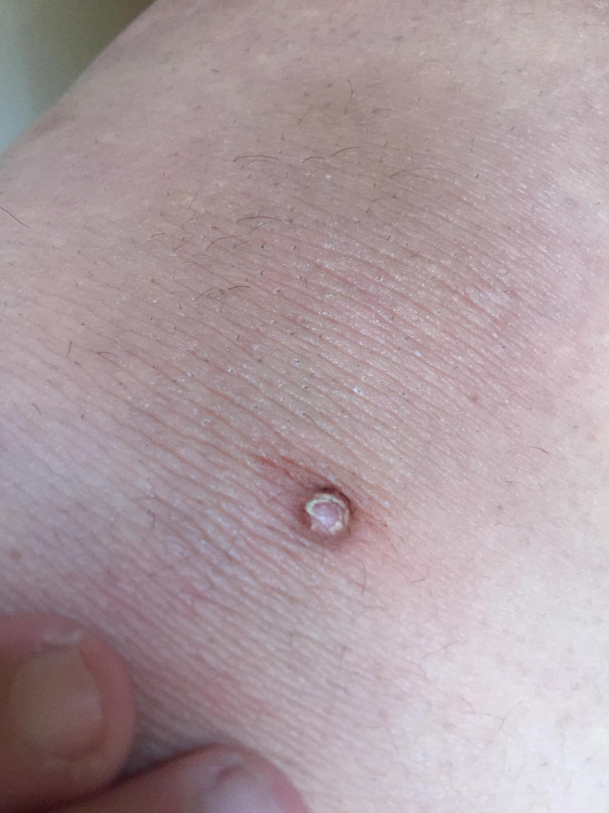 Is this a wart? It popped up on my knee a while back and
