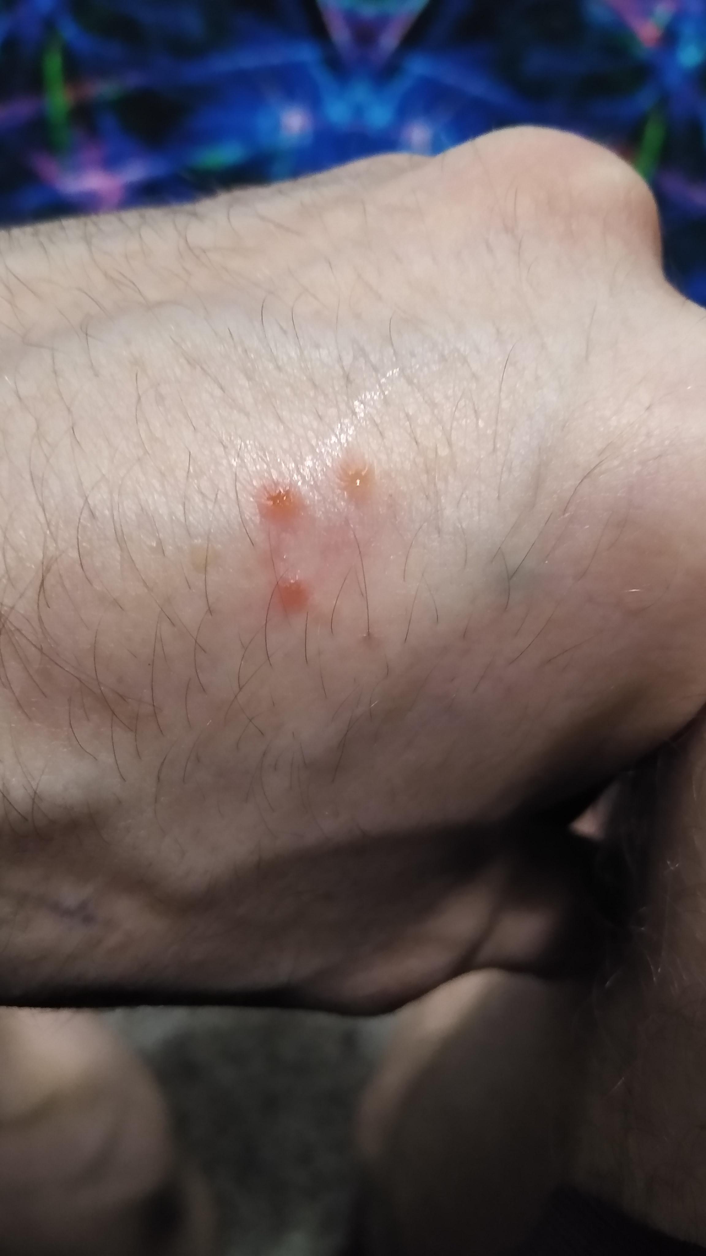 Eczema or something else? Worst triggers seem to be sweat, hot water