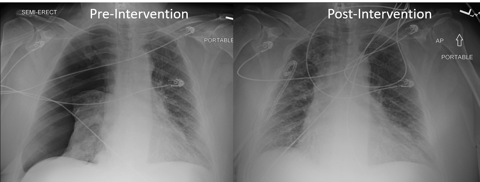 Radiology Case Shortness of Breath [clinical] r/medicalschool