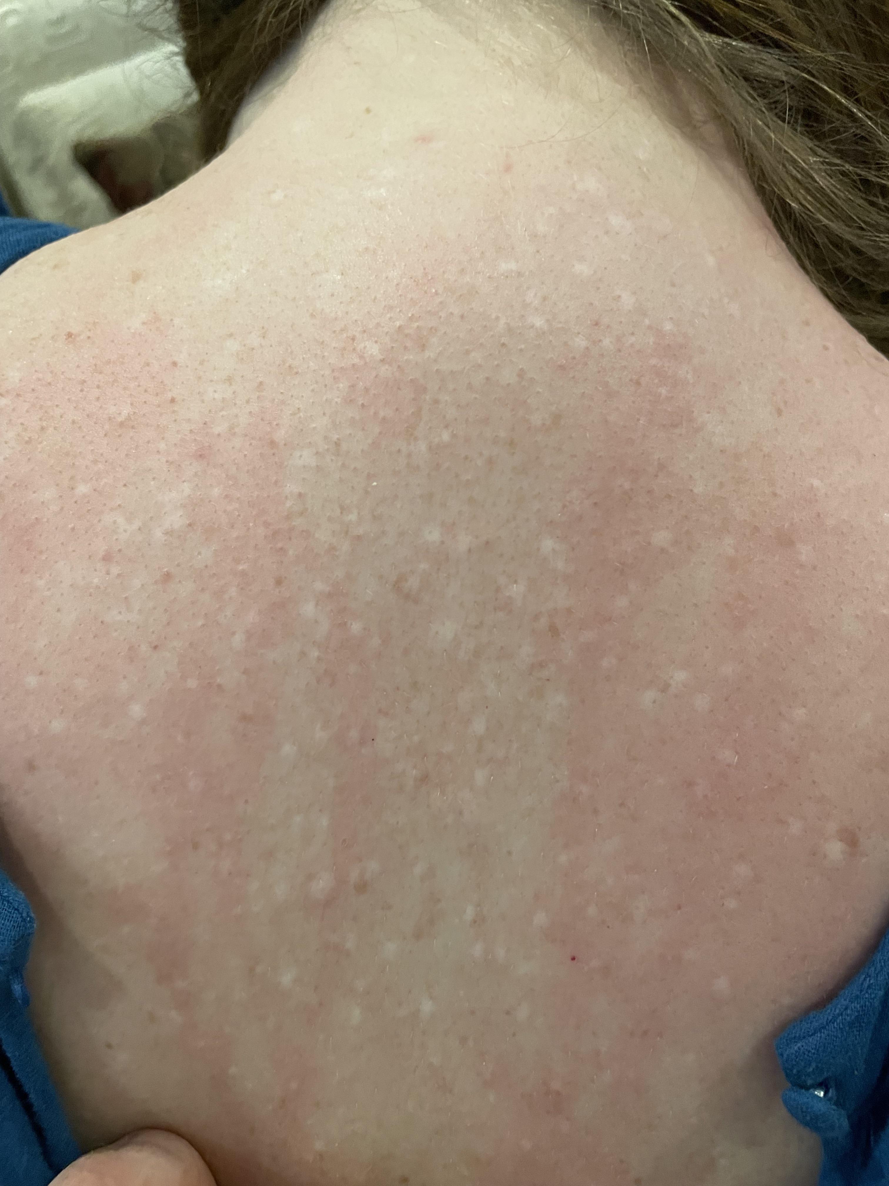 White dots on skin, not raised. What is it? r/DermatologyQuestions
