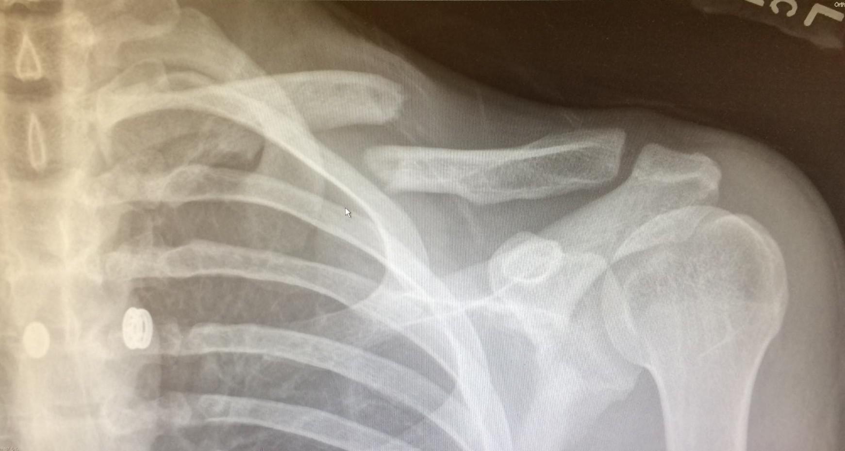 Broken clavicle, after eating it good on a skateboard. r/MedicalGore