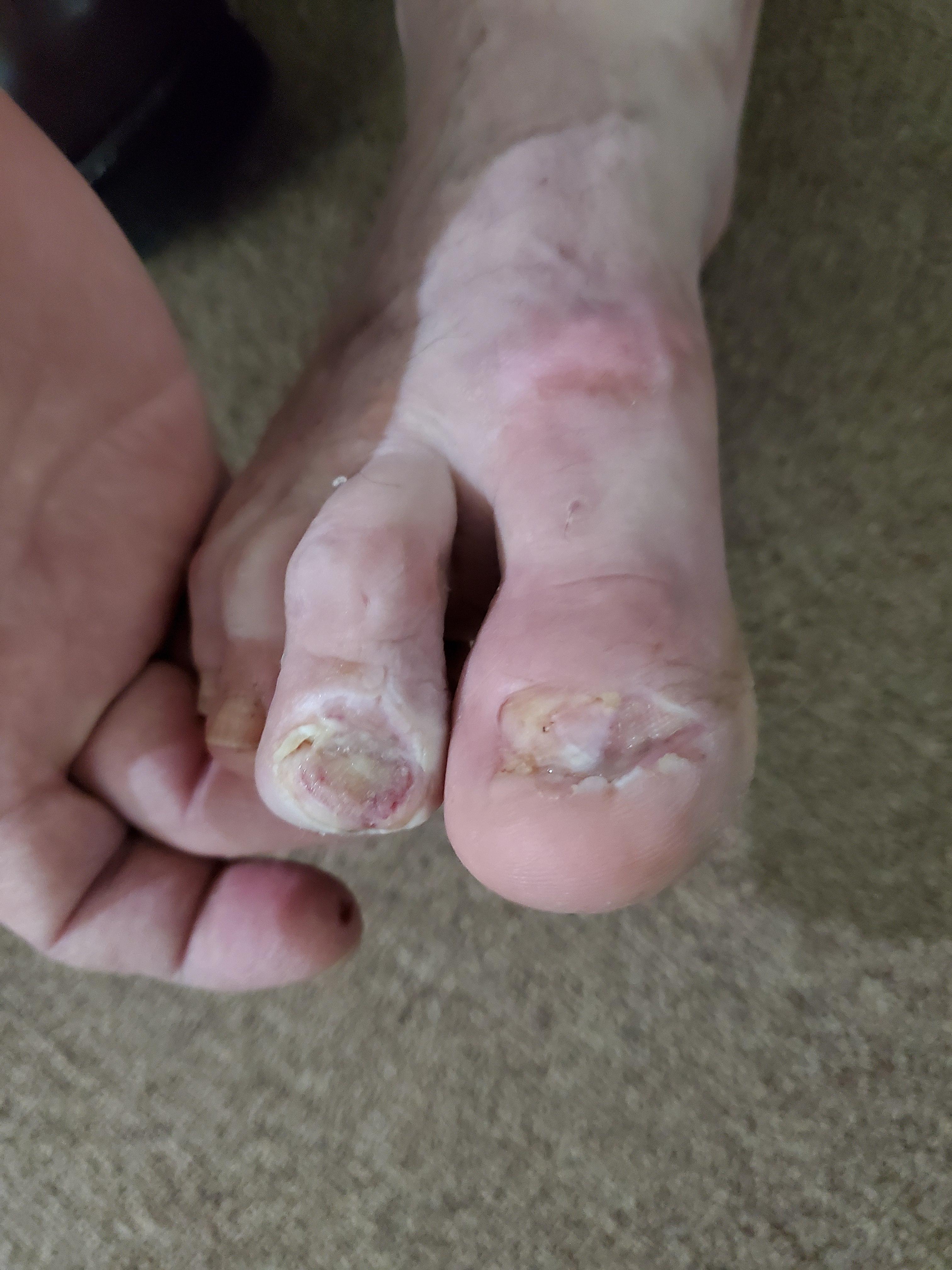 Ingrown Toenails