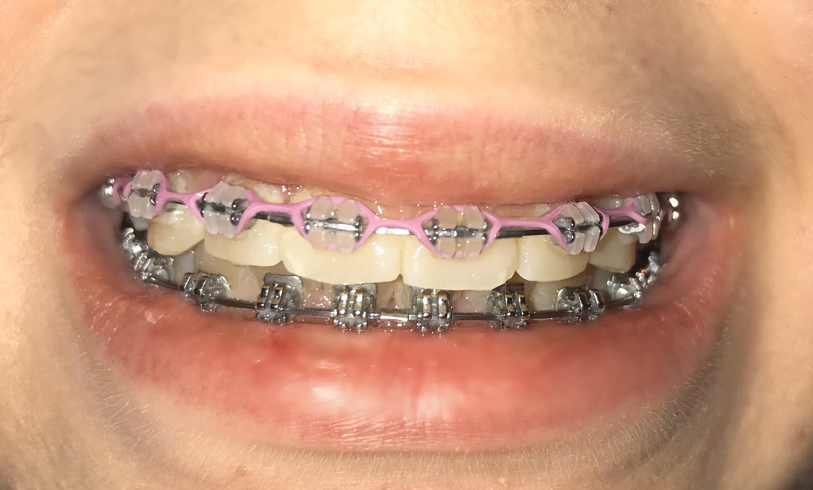 i was supposed to get my braces off this summer after 4 years 😢😢 r/braces