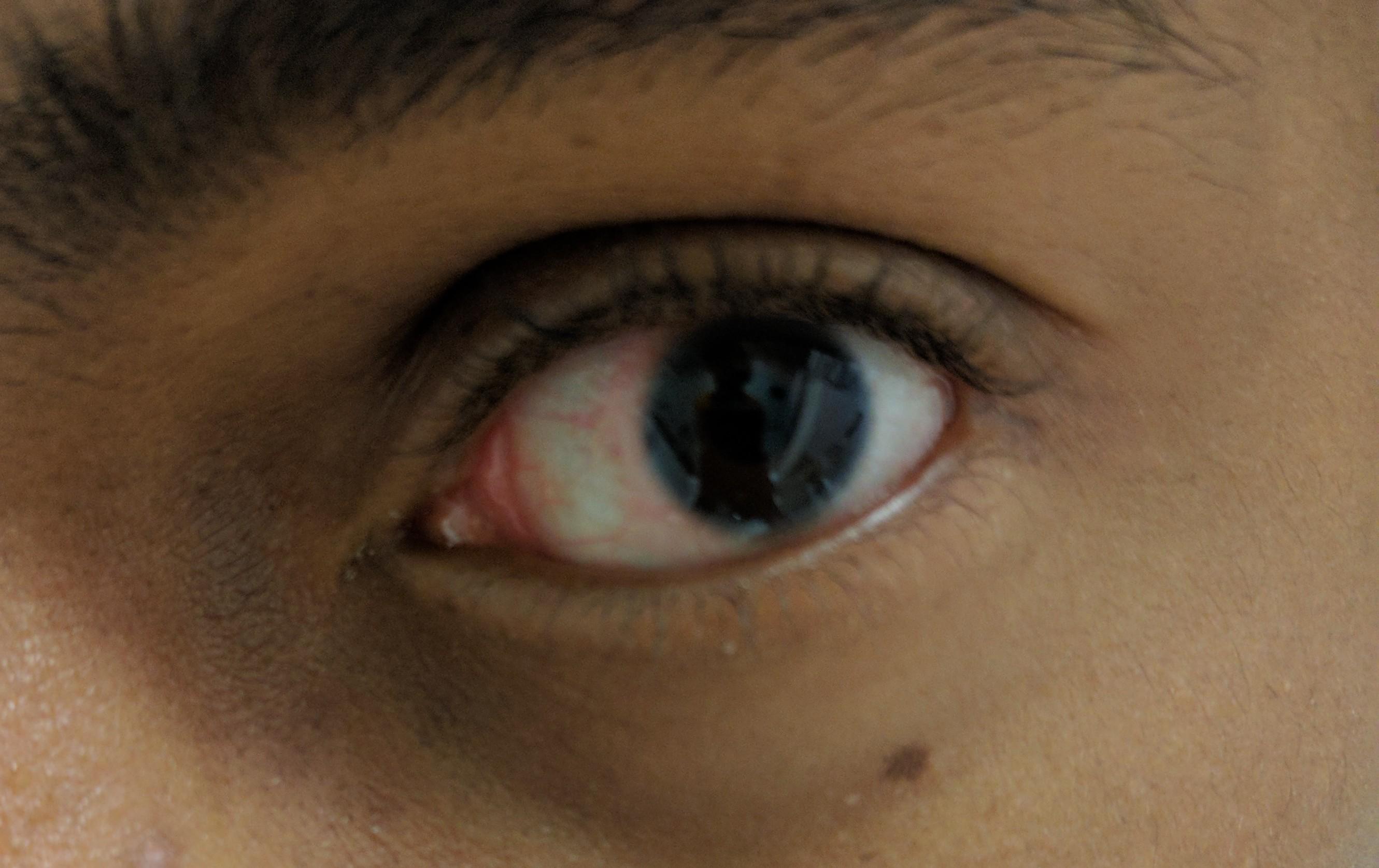 Details more than 124 ring around pupil super hot xkldase.edu.vn